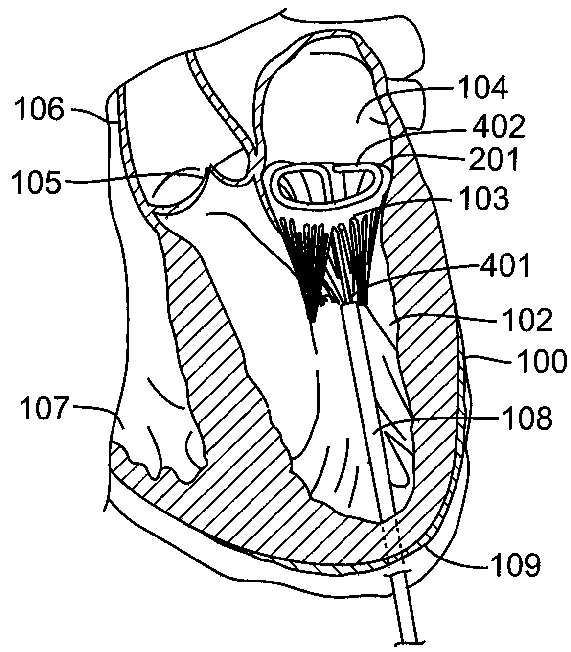 Percutaneous Interventional Cardiology System for Treating Valvular Disease