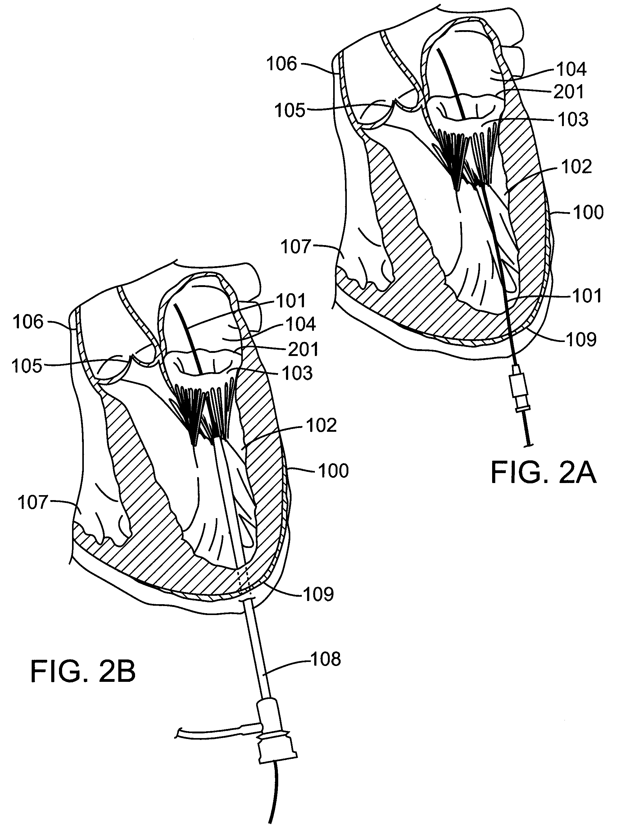 Percutaneous Interventional Cardiology System for Treating Valvular Disease