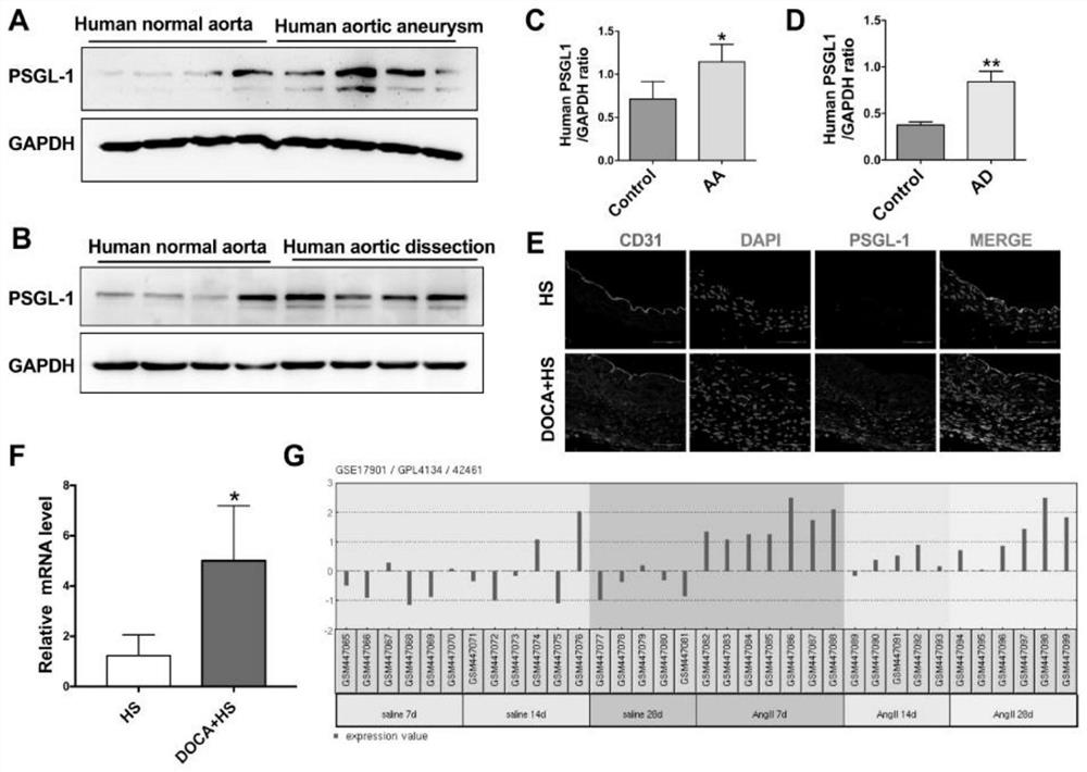 Application of recombinant P-selectin glycoprotein ligand 1 as a target in preparation of drugs for preventing and/or treating aneurysms