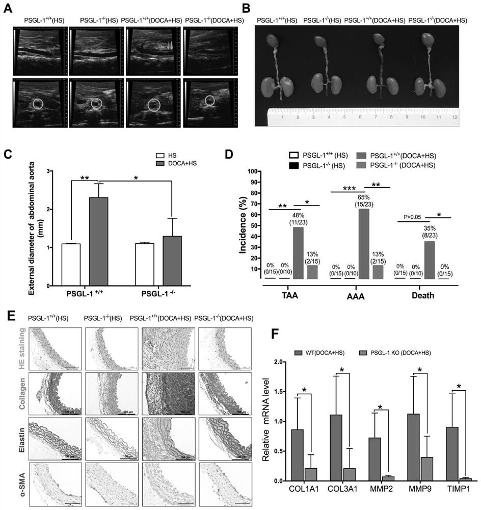 Application of recombinant P-selectin glycoprotein ligand 1 as a target in preparation of drugs for preventing and/or treating aneurysms