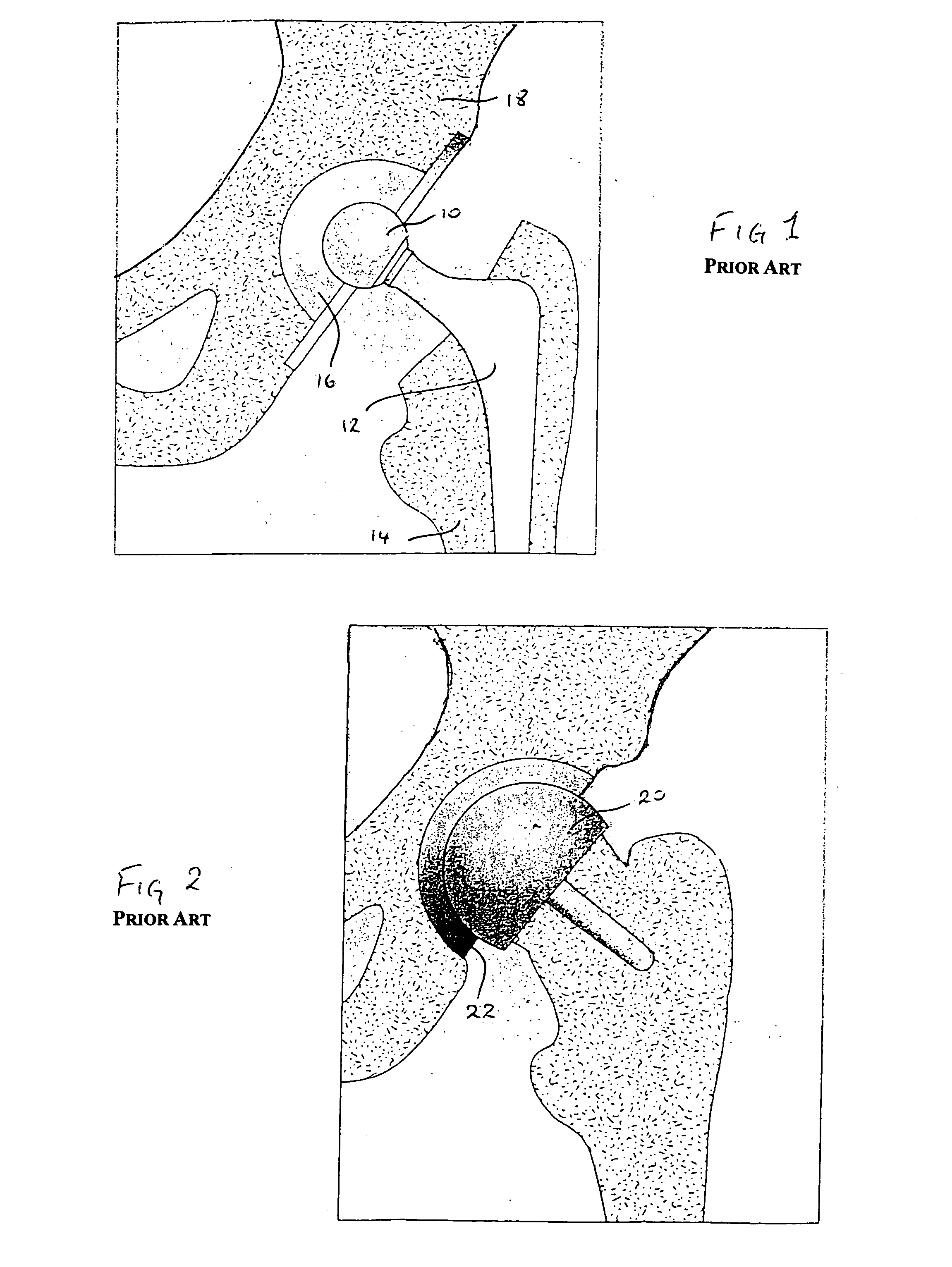 Head centering jig for femoral resurfacing