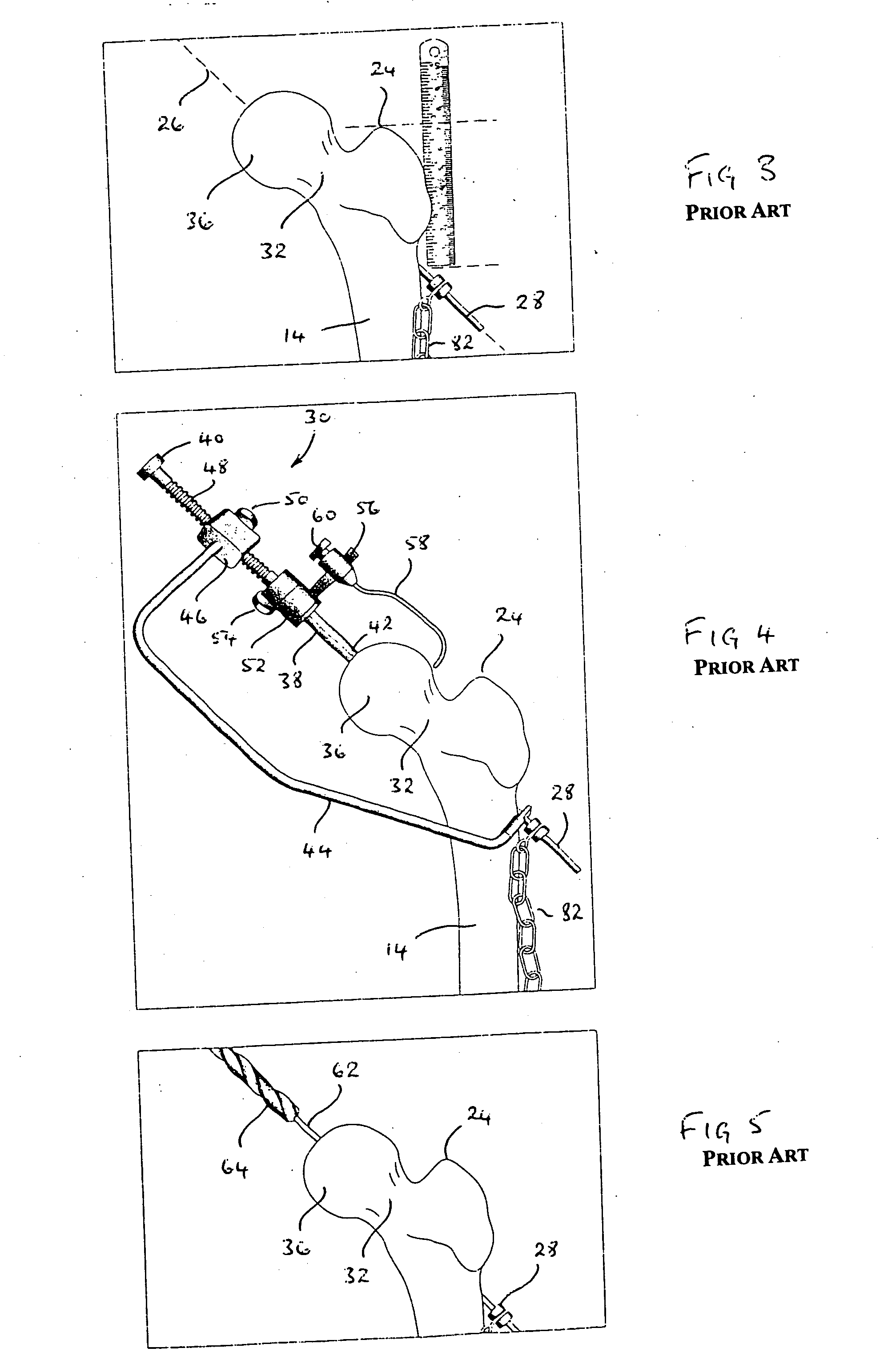 Head centering jig for femoral resurfacing