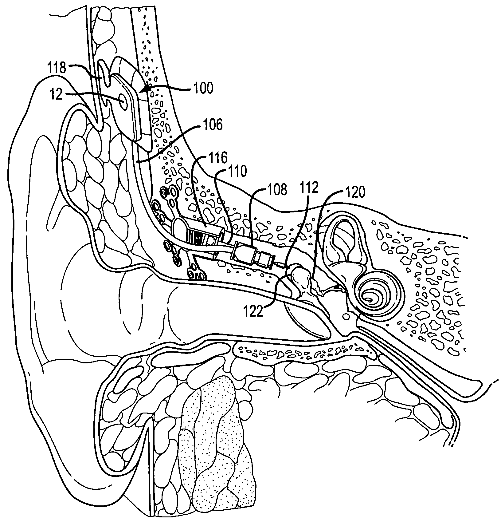 Active vibration attenuation for implantable microphone