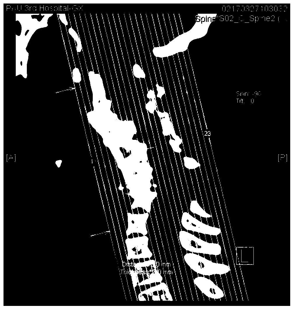 A preparation method of human airway and cervical vertebra 3D printing model