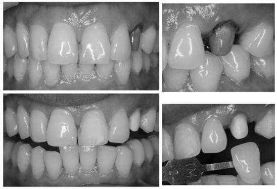 Dental mineralization and bleaching double-functional paste, preparation method and application