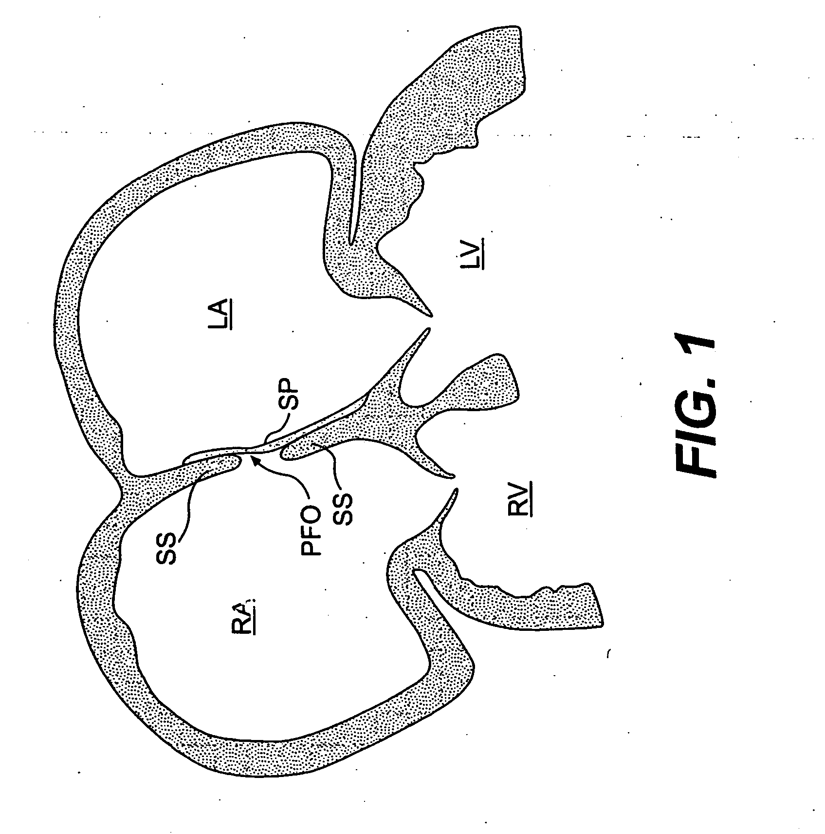 Closure devices, related delivery methods, and related methods of use