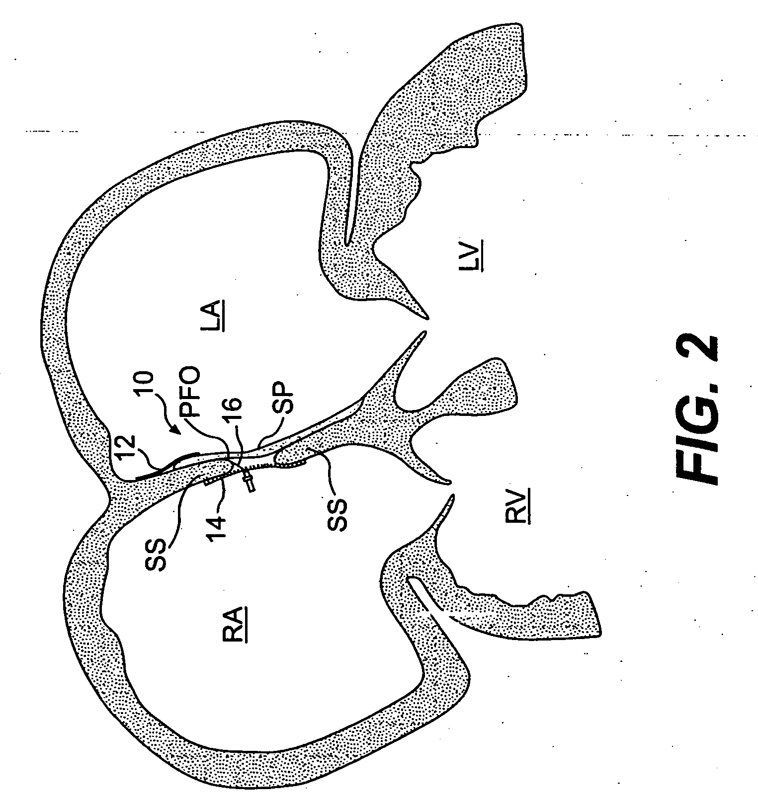 Closure devices, related delivery methods, and related methods of use