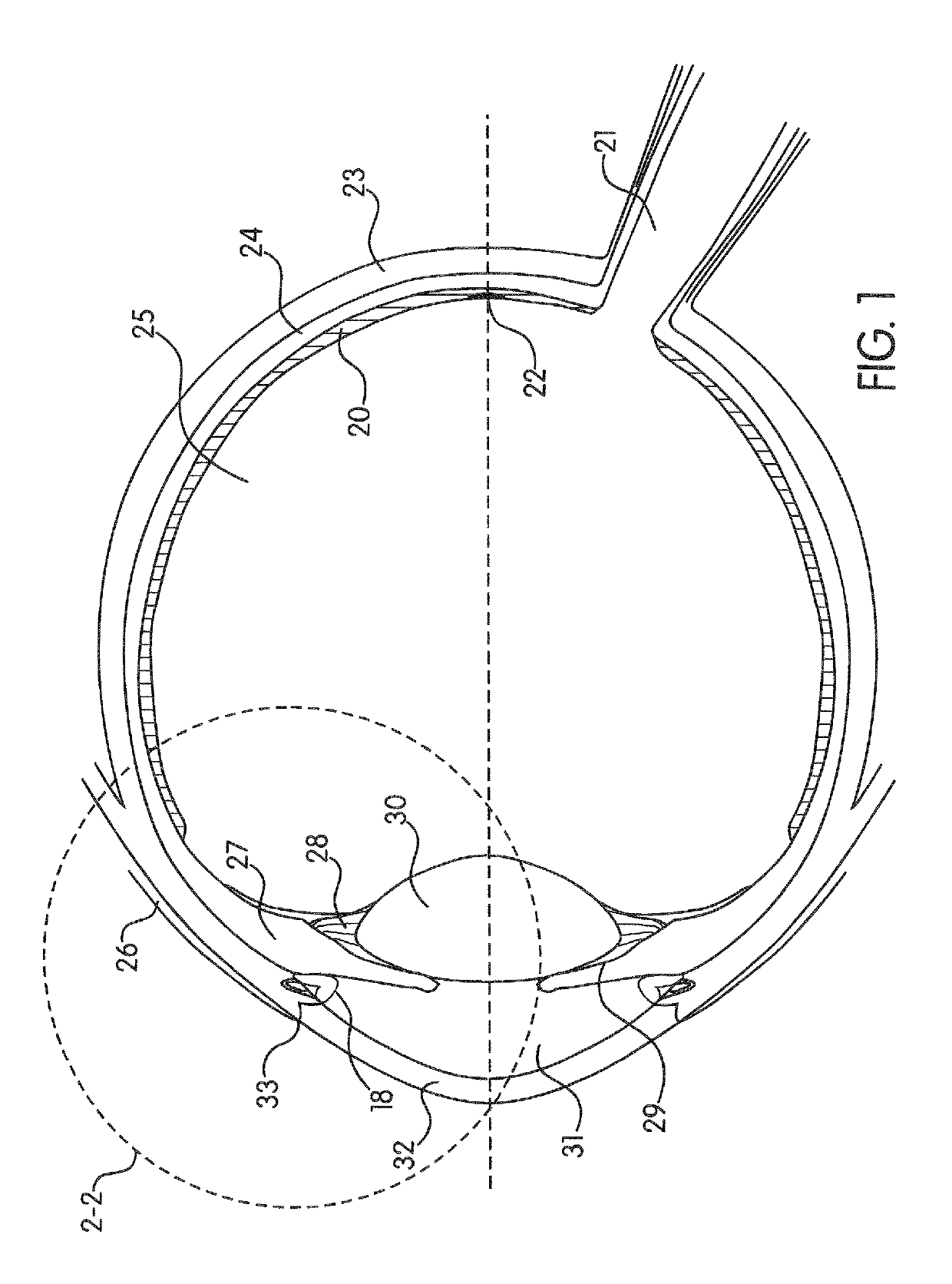 Ocular collar stent for treating narrowing of the irideocorneal angle