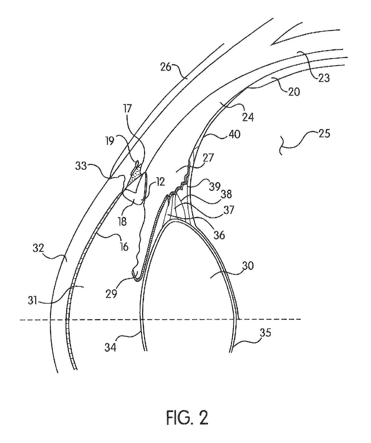 Ocular collar stent for treating narrowing of the irideocorneal angle