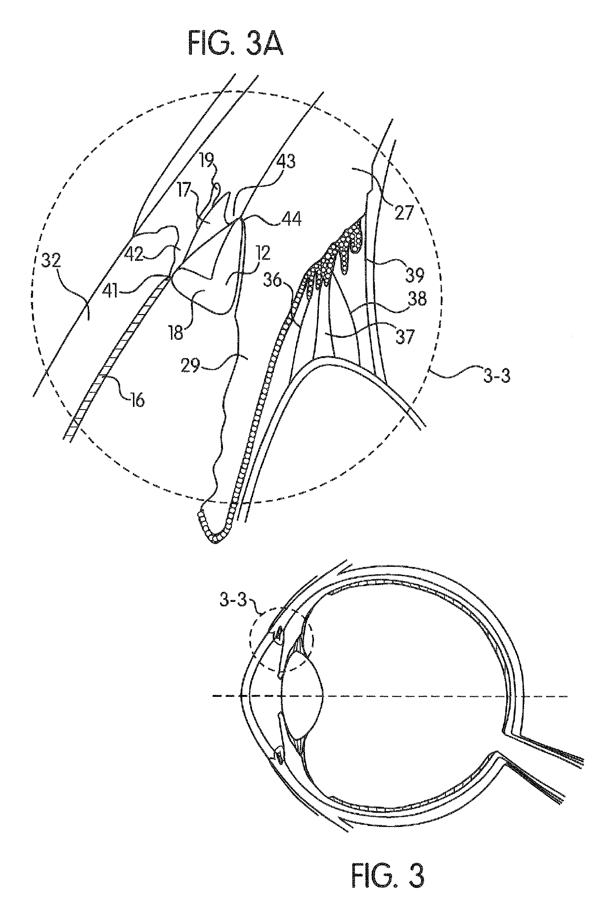 Ocular collar stent for treating narrowing of the irideocorneal angle