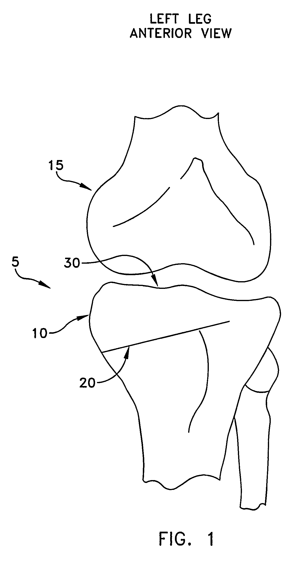 Method and apparatus for performing an open wedge, high tibial osteotomy