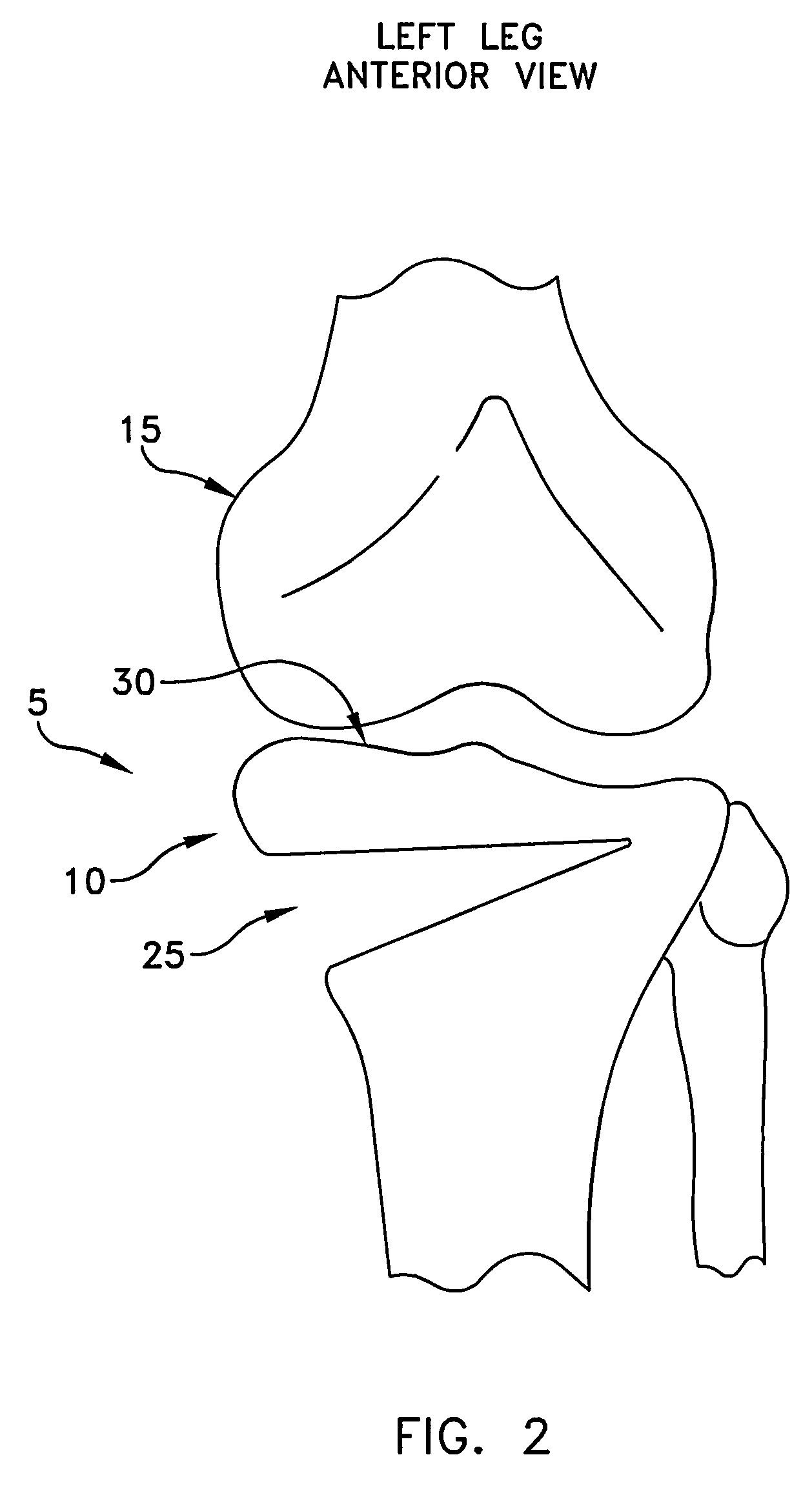 Method and apparatus for performing an open wedge, high tibial osteotomy