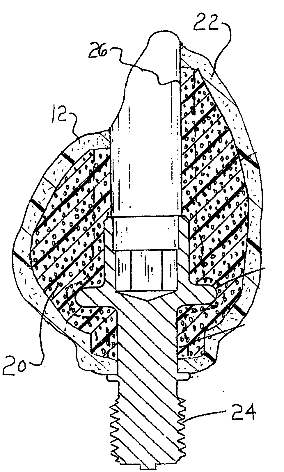 Polymer Core Prosthetic Dental Device with an Esthetic Surface