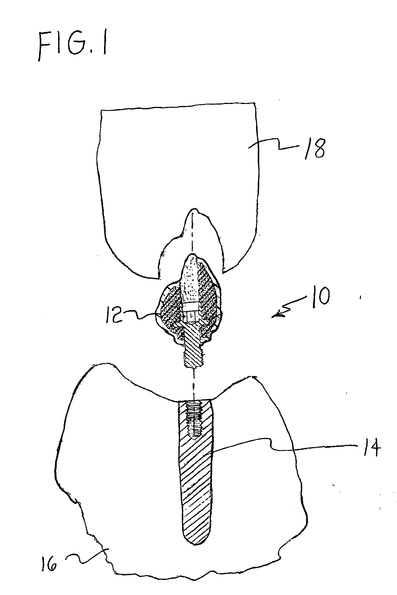 Polymer Core Prosthetic Dental Device with an Esthetic Surface