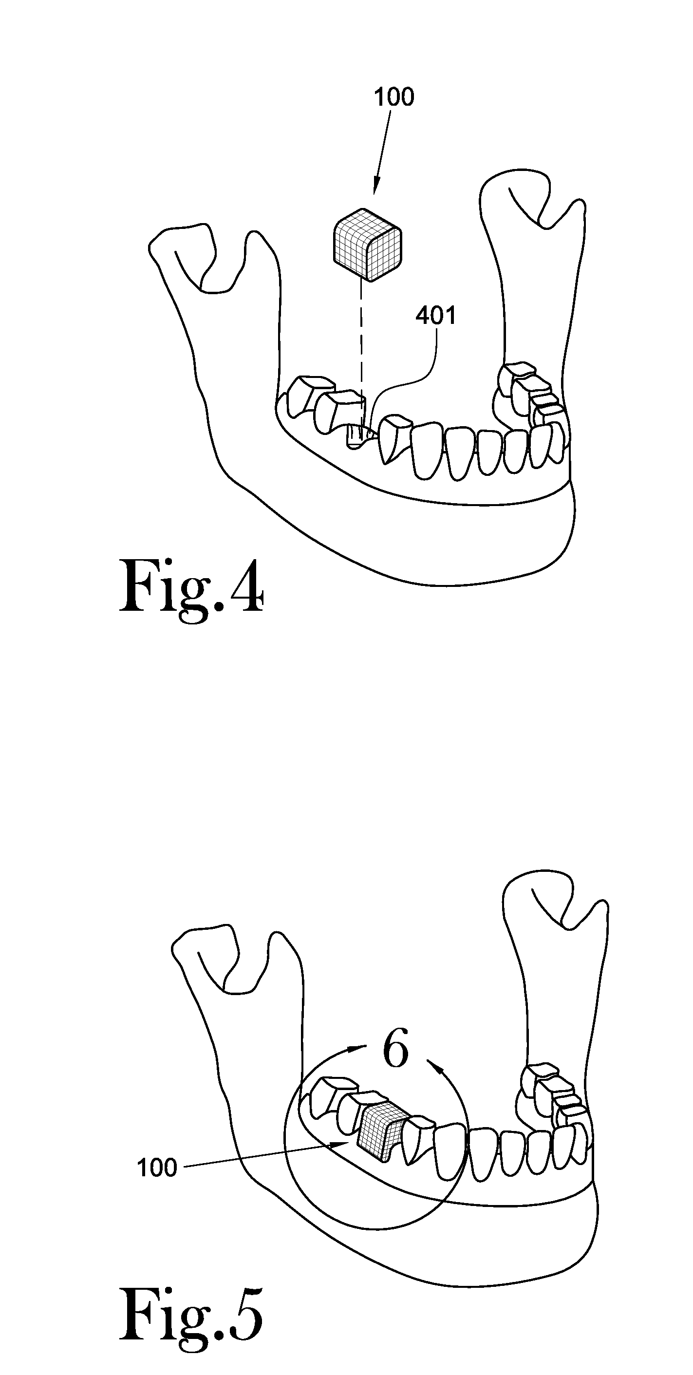 Dental Wound Dressing