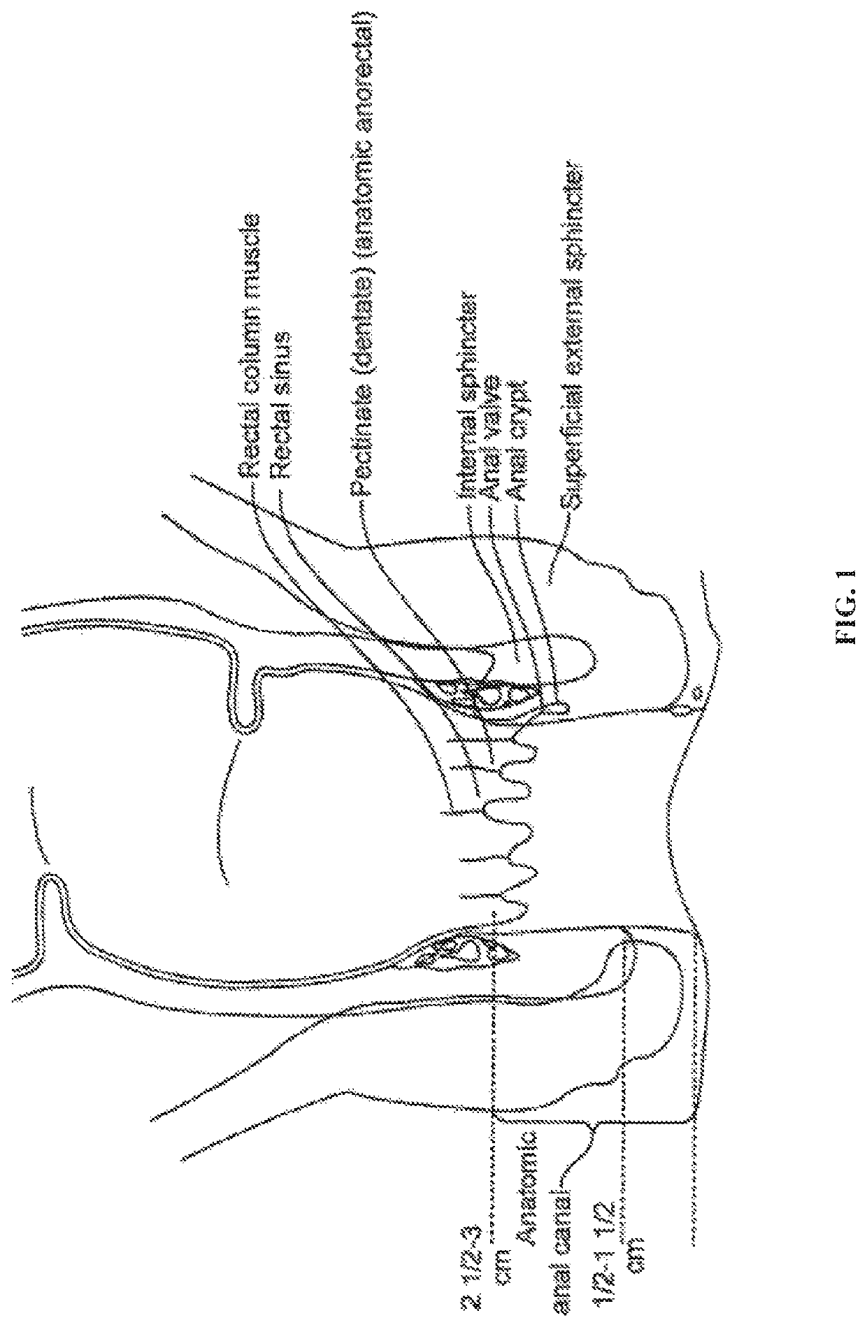 Fecal incontinence device for positioning in the lower rectum