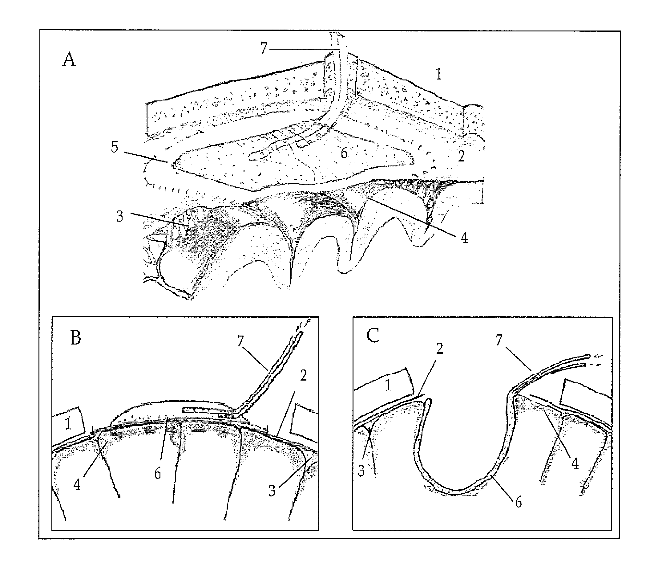 Device to reduce brain edema by surface dialysis and cooling