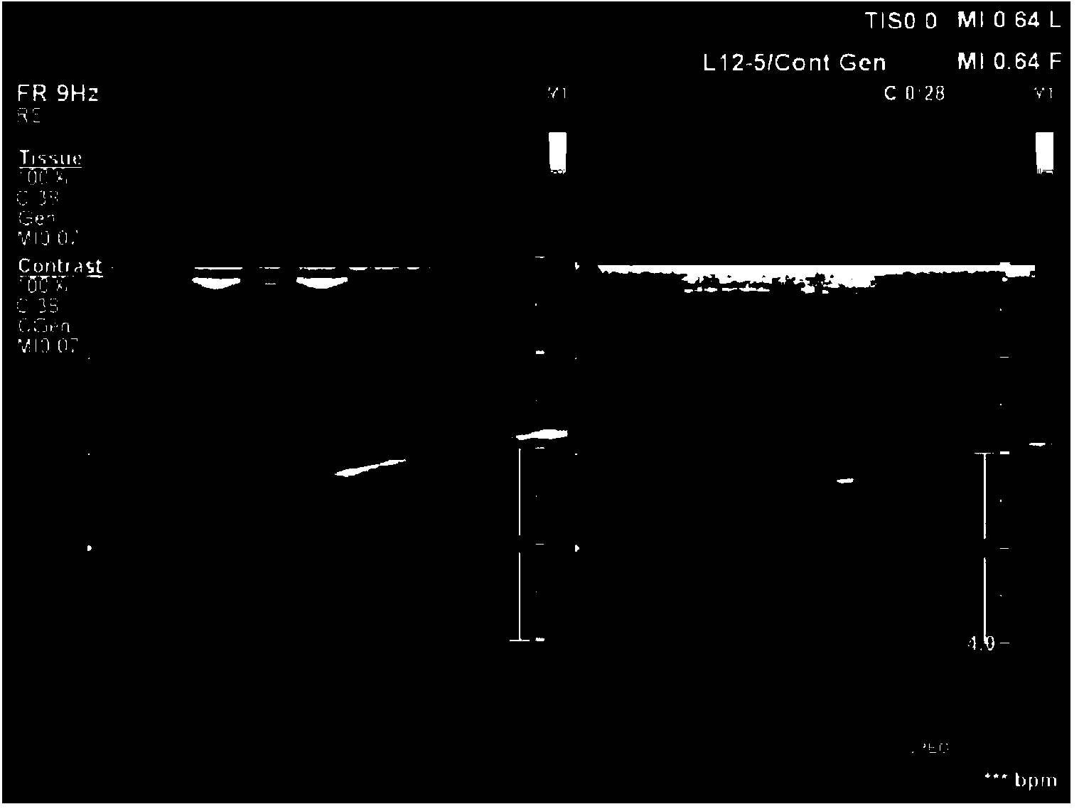 Microbubble ultrasound contrast agent containing mitomycin C as well as preparation method and use thereof