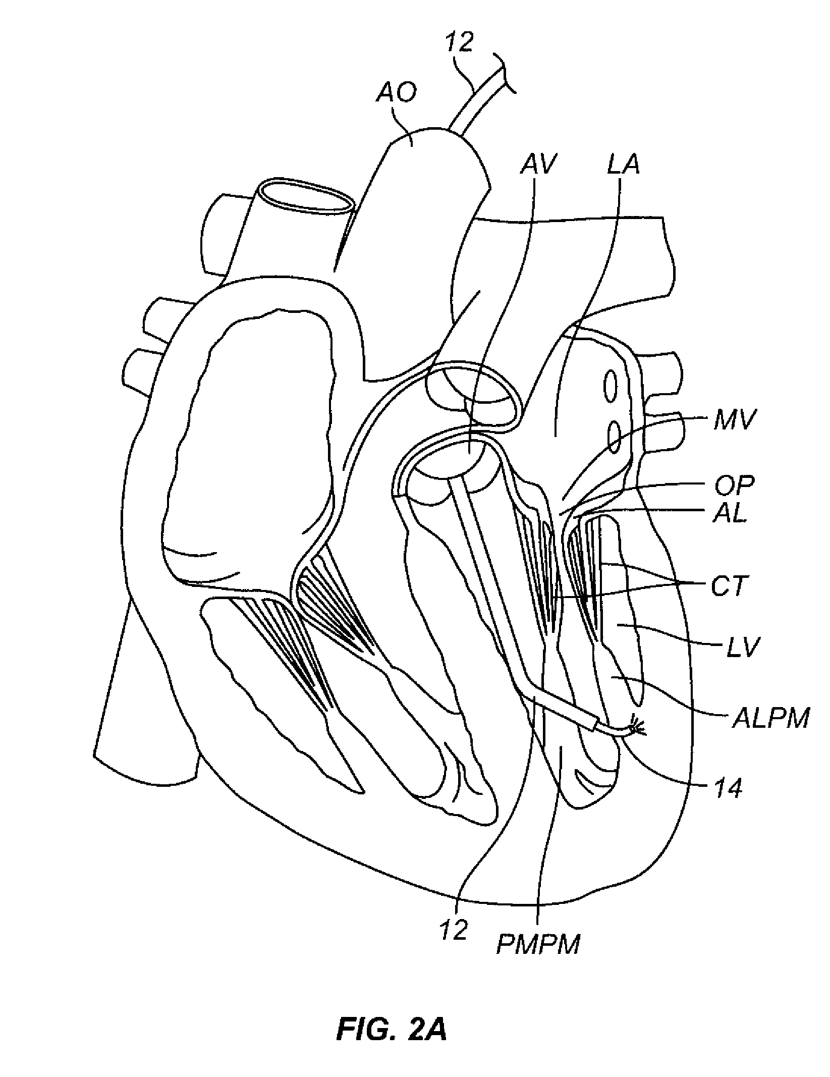 Repair of Incompetent Heart Valves by Papillary Muscle Bulking