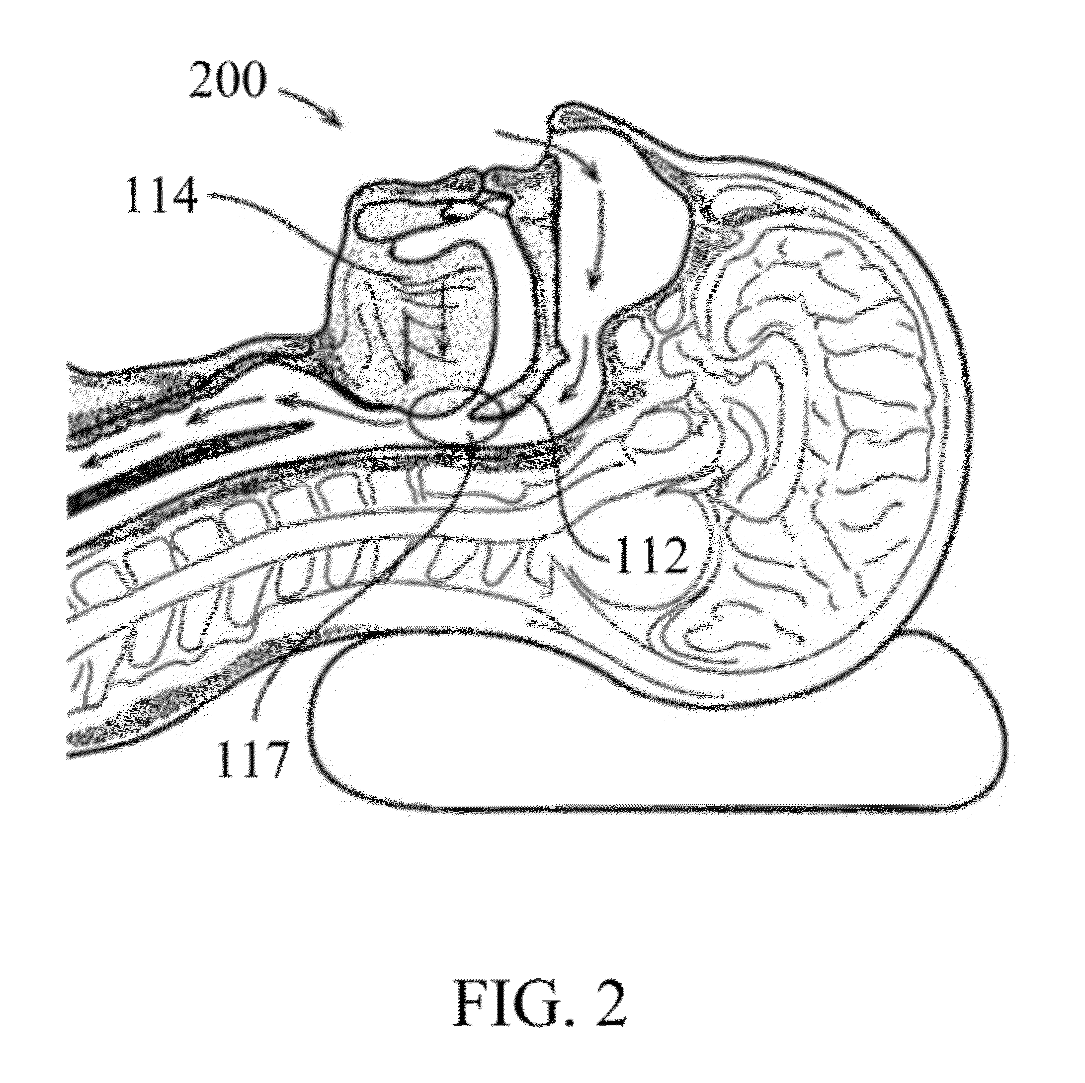 Devise for snoring and obstructive sleep apnea treatment