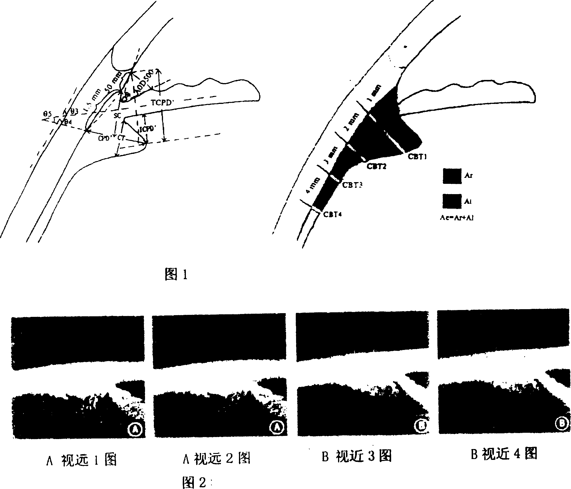 Use of zijing in preparing preparation for treating shortsightedness