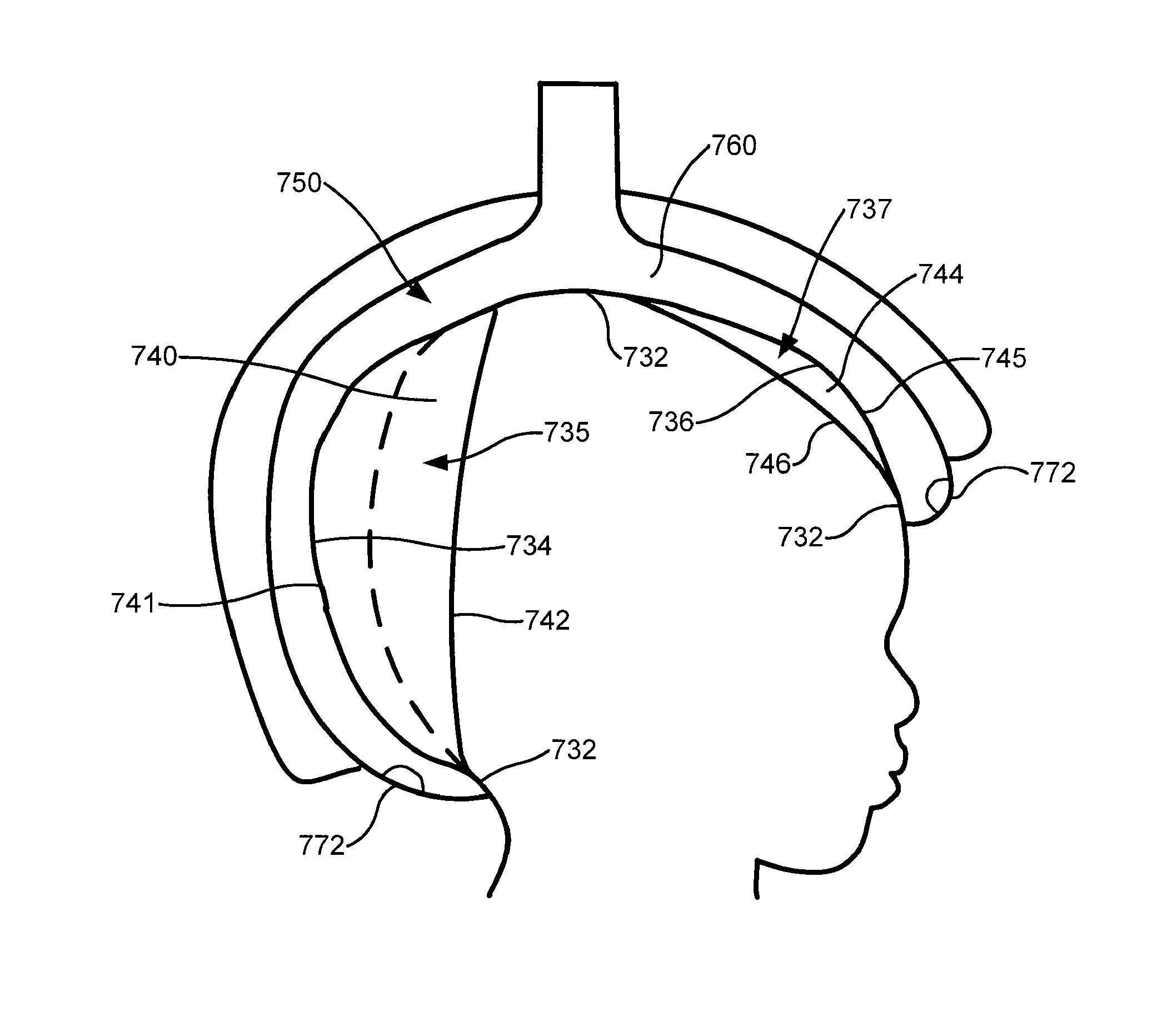 In situ molded orthotic and method for its fabrication