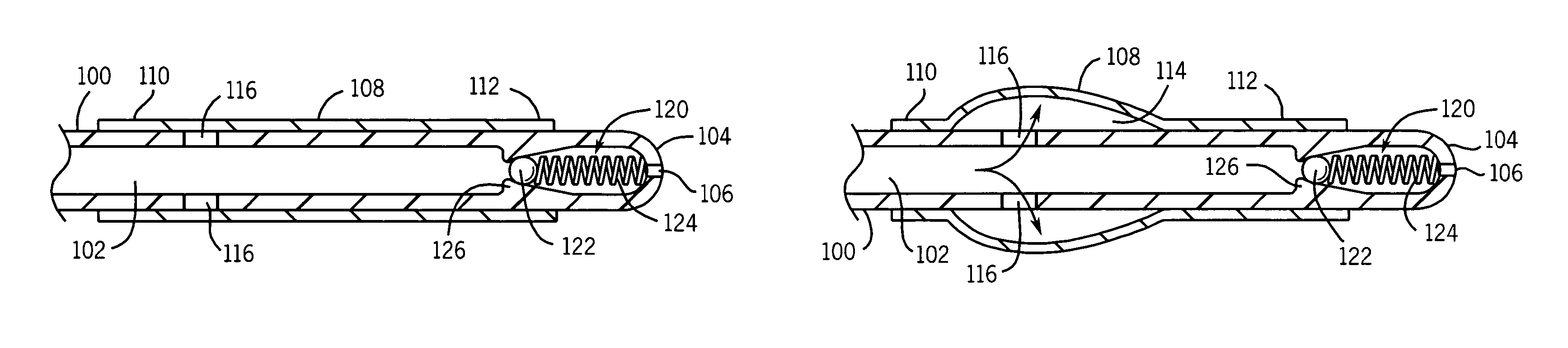 Catheter with autoinflating, autoregulating balloon