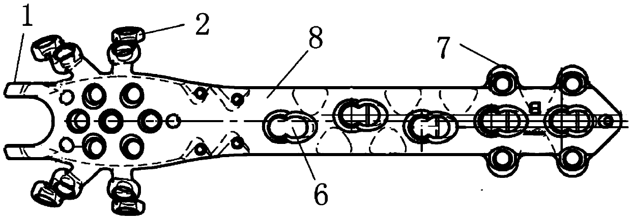 Claw-shaped greater trochanter locking bone fracture plate with side wings