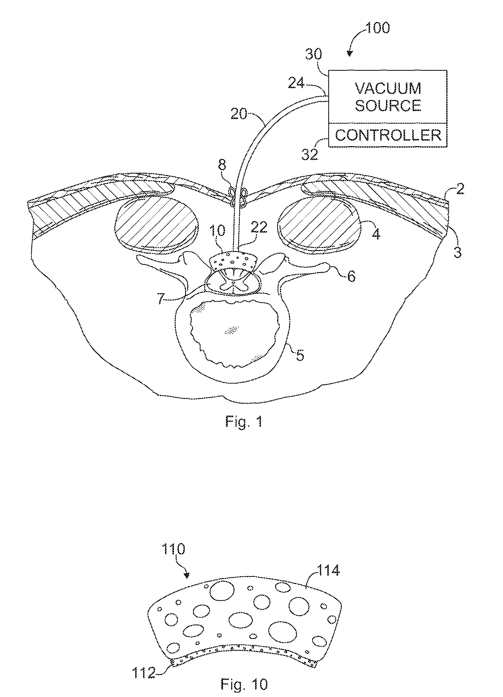 Devices and methods for treating spinal cord tissue