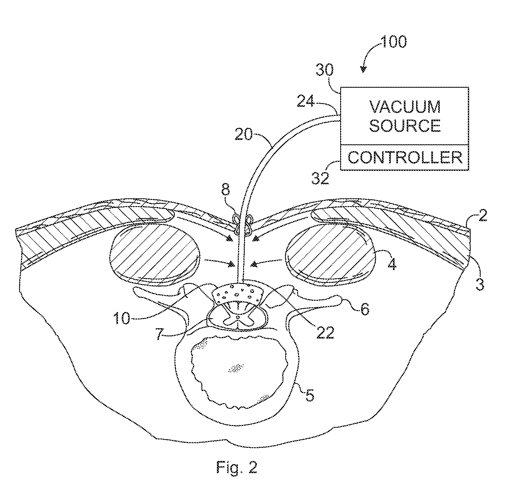 Devices and methods for treating spinal cord tissue