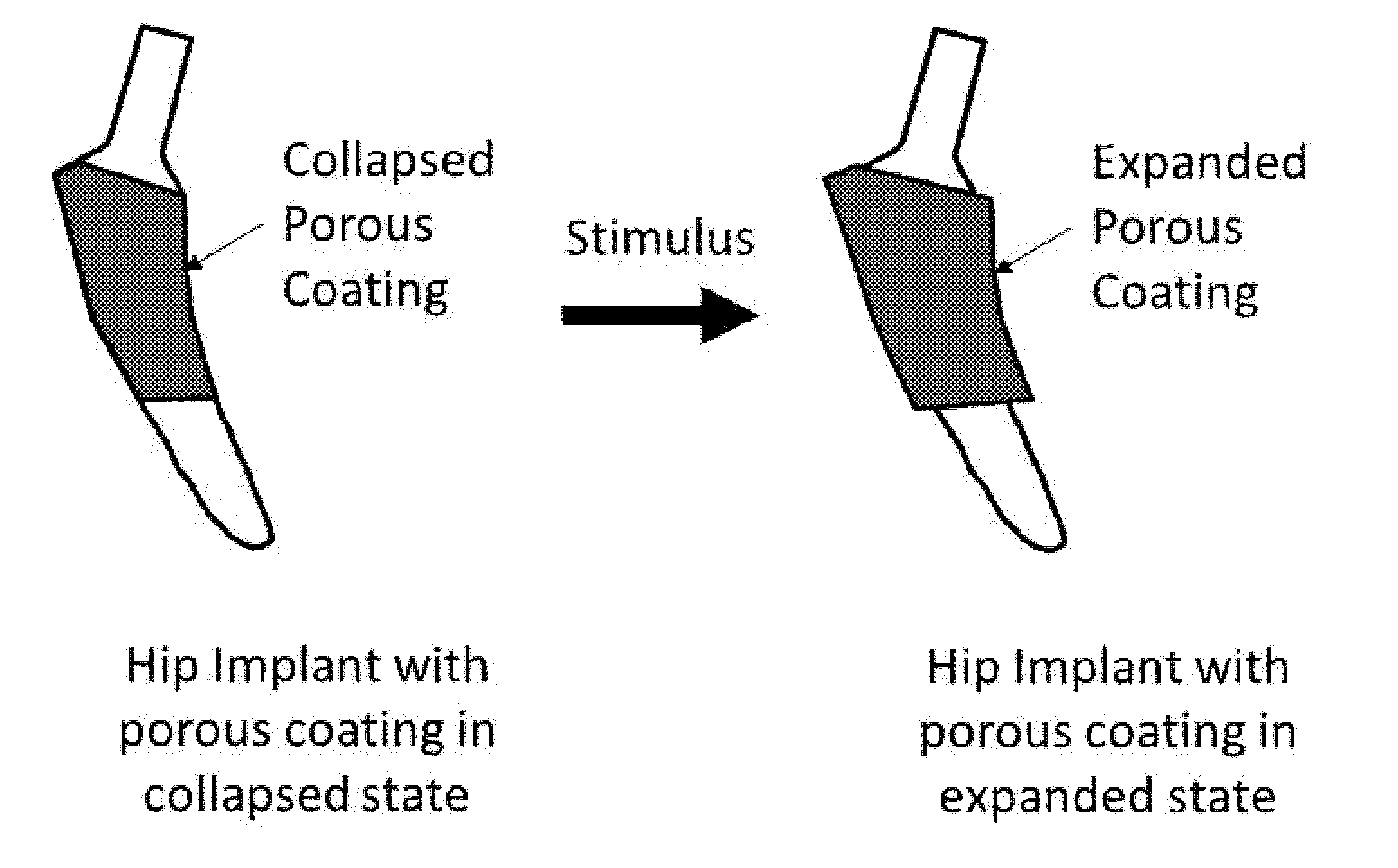 Porous coating for orthopedic implant utilizing porous, shape memory materials