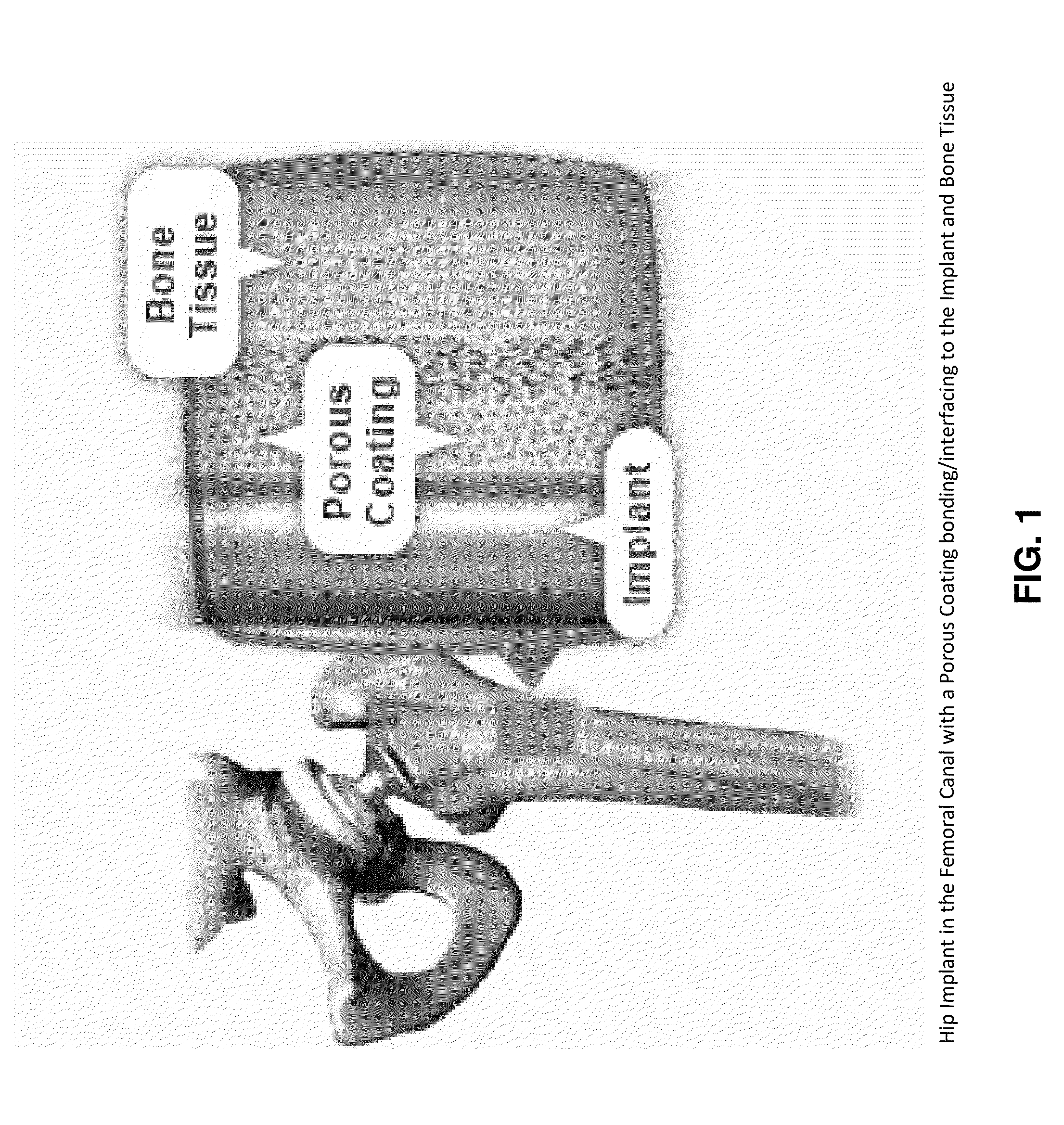 Porous coating for orthopedic implant utilizing porous, shape memory materials