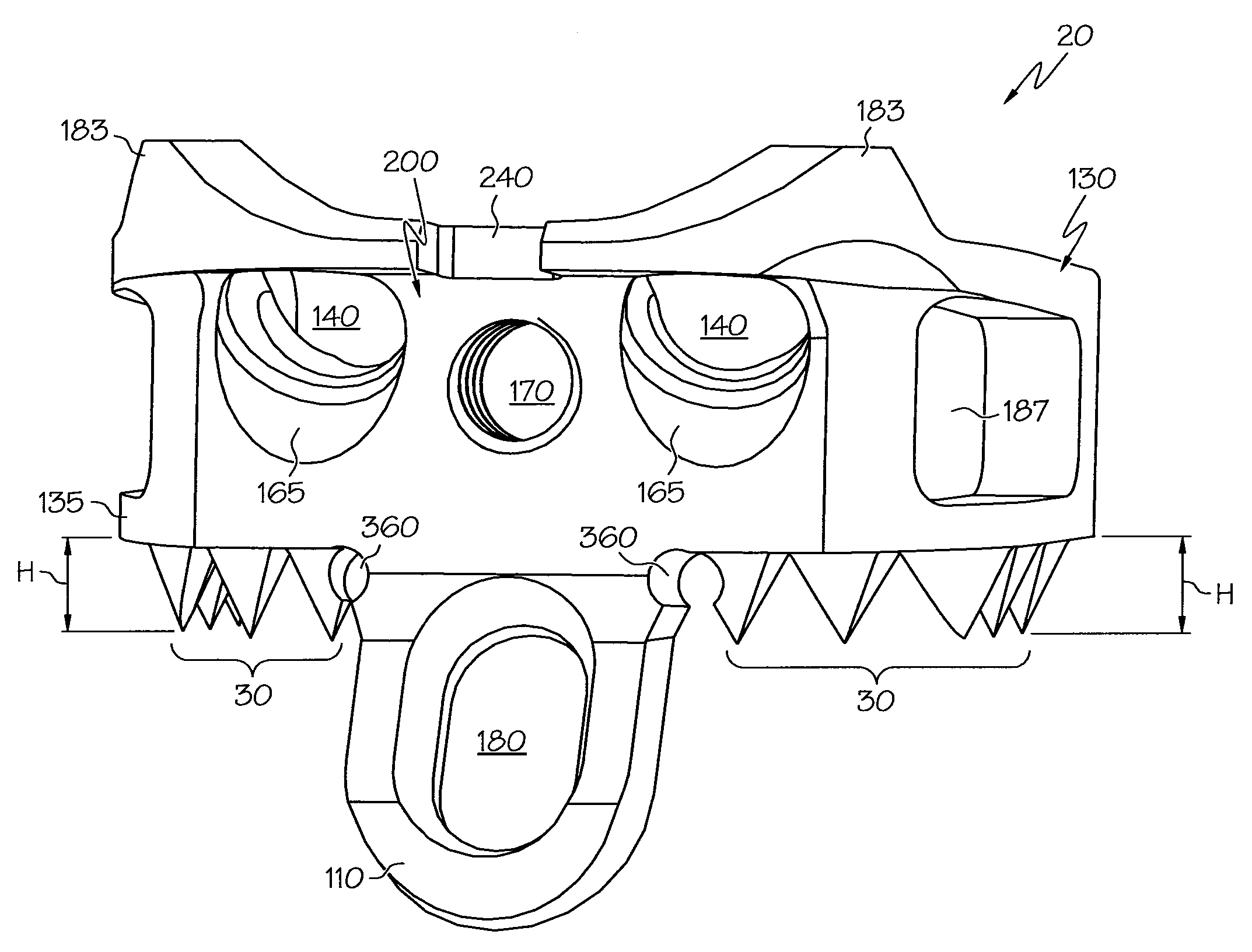 Implant subsidence control