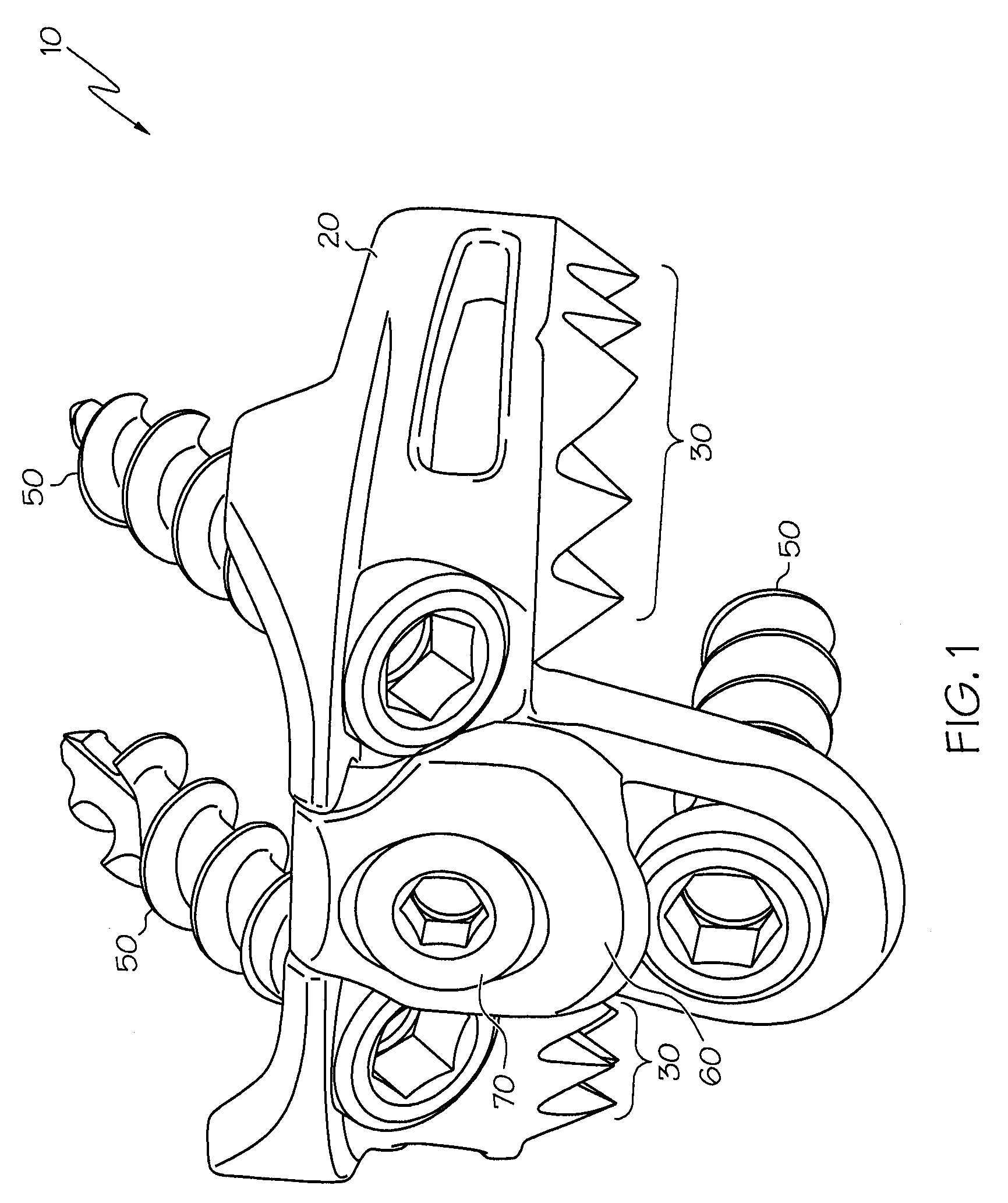 Implant subsidence control