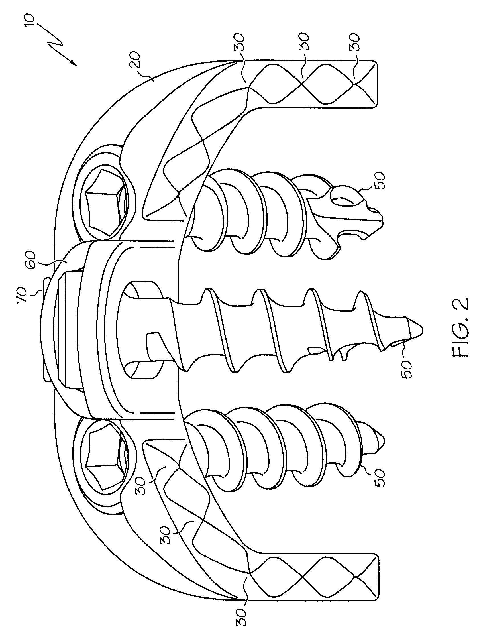 Implant subsidence control