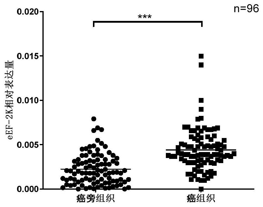 Application of eEF-2K protein and coding gene thereof in liver tumor diagnosis and treatment