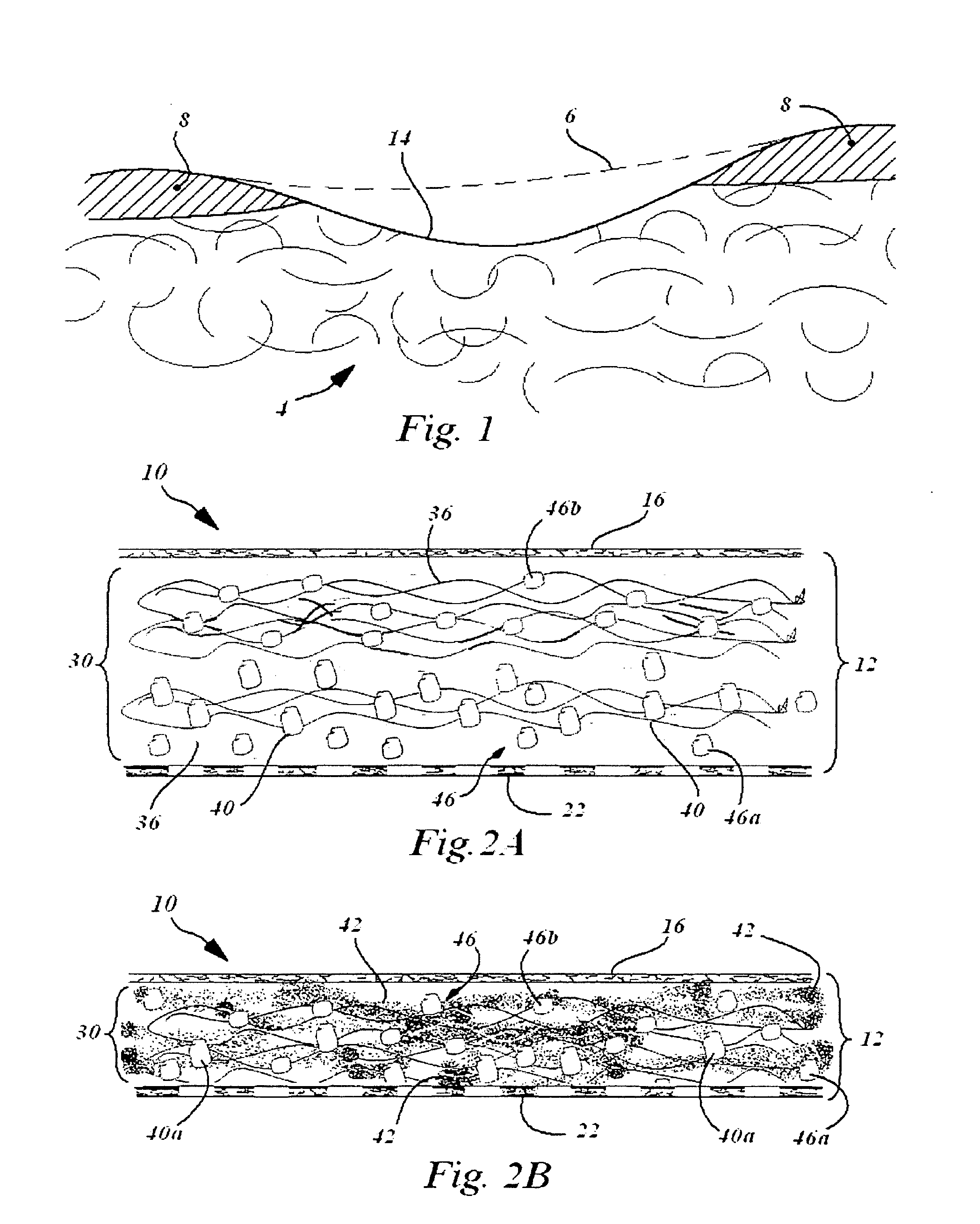 In situ system for intra-articular chondral and osseus tissue repair