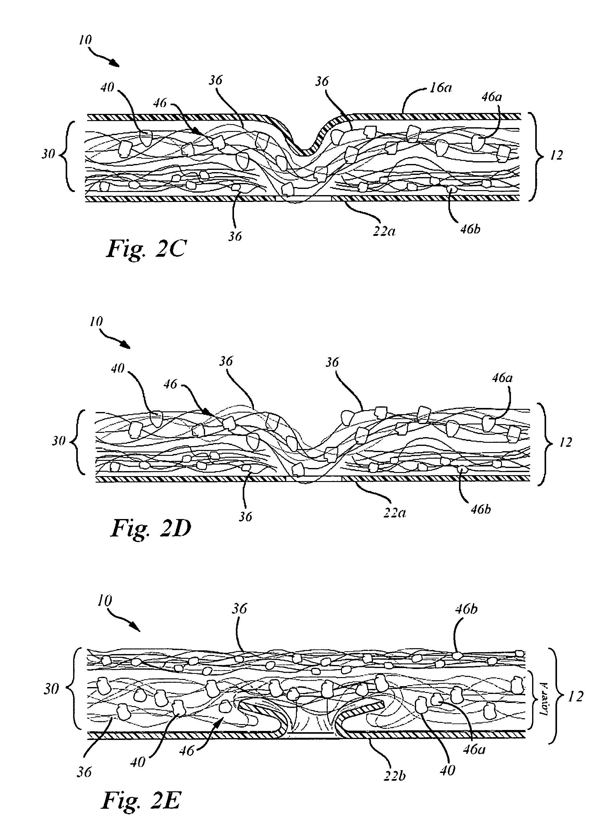 In situ system for intra-articular chondral and osseus tissue repair