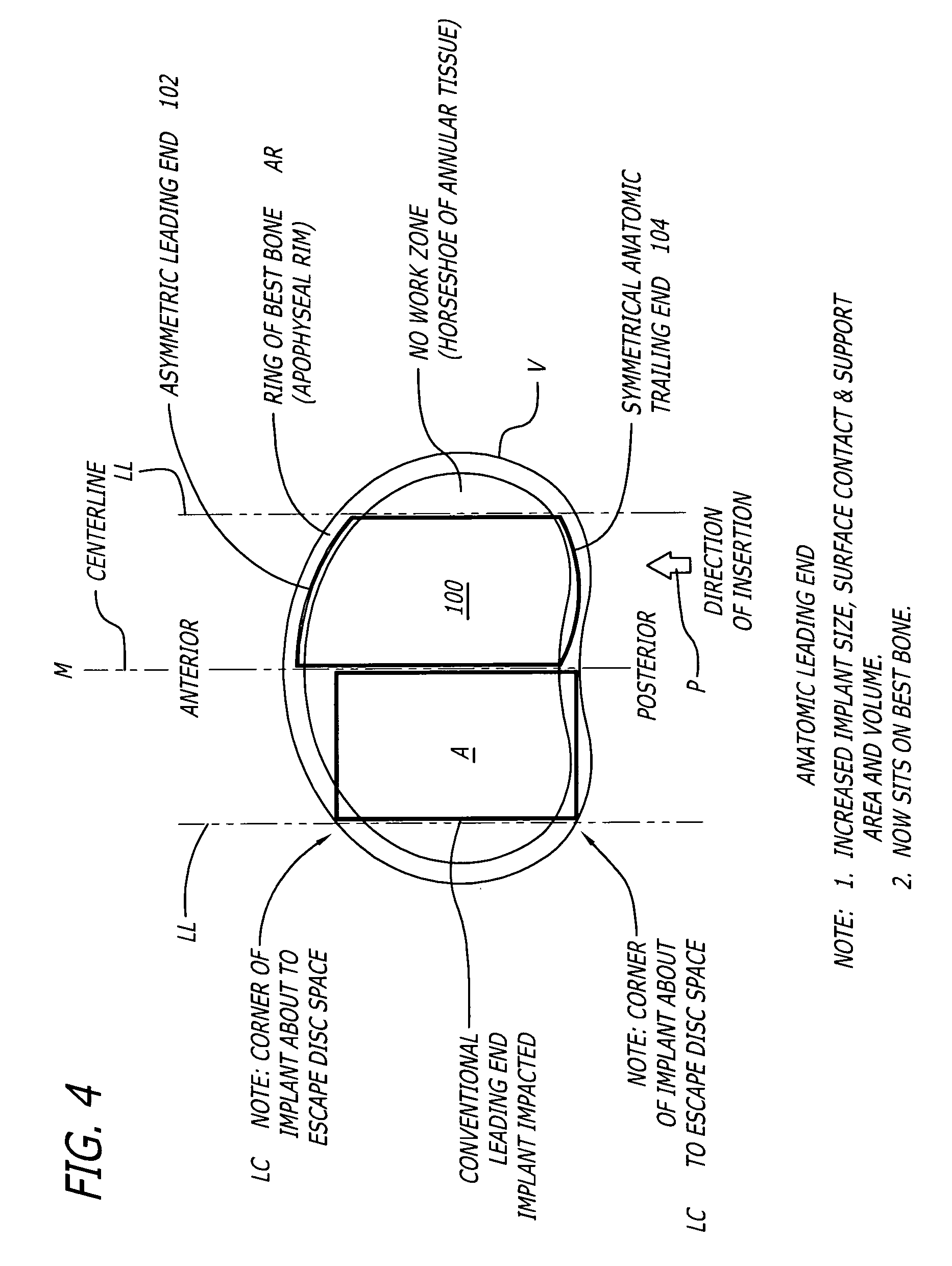 Method for installation of artificial hemi-lumbar interbody spinal fusion implant having an asymmetrical leading end