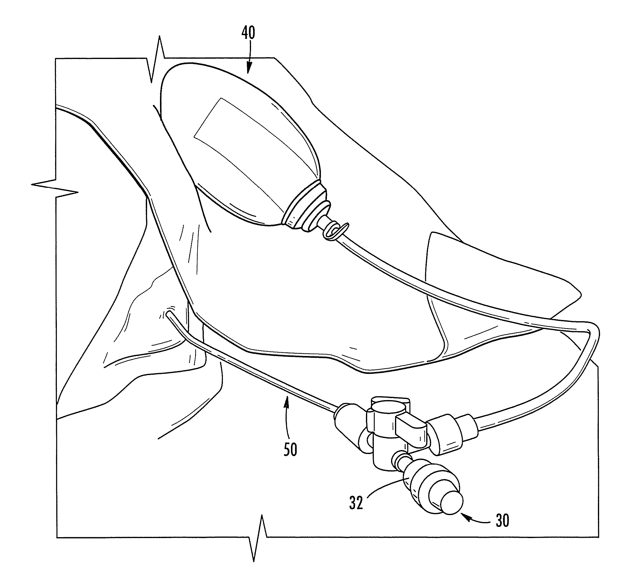 Subdural Drainage Catheter with Flow Restoration Mechanism