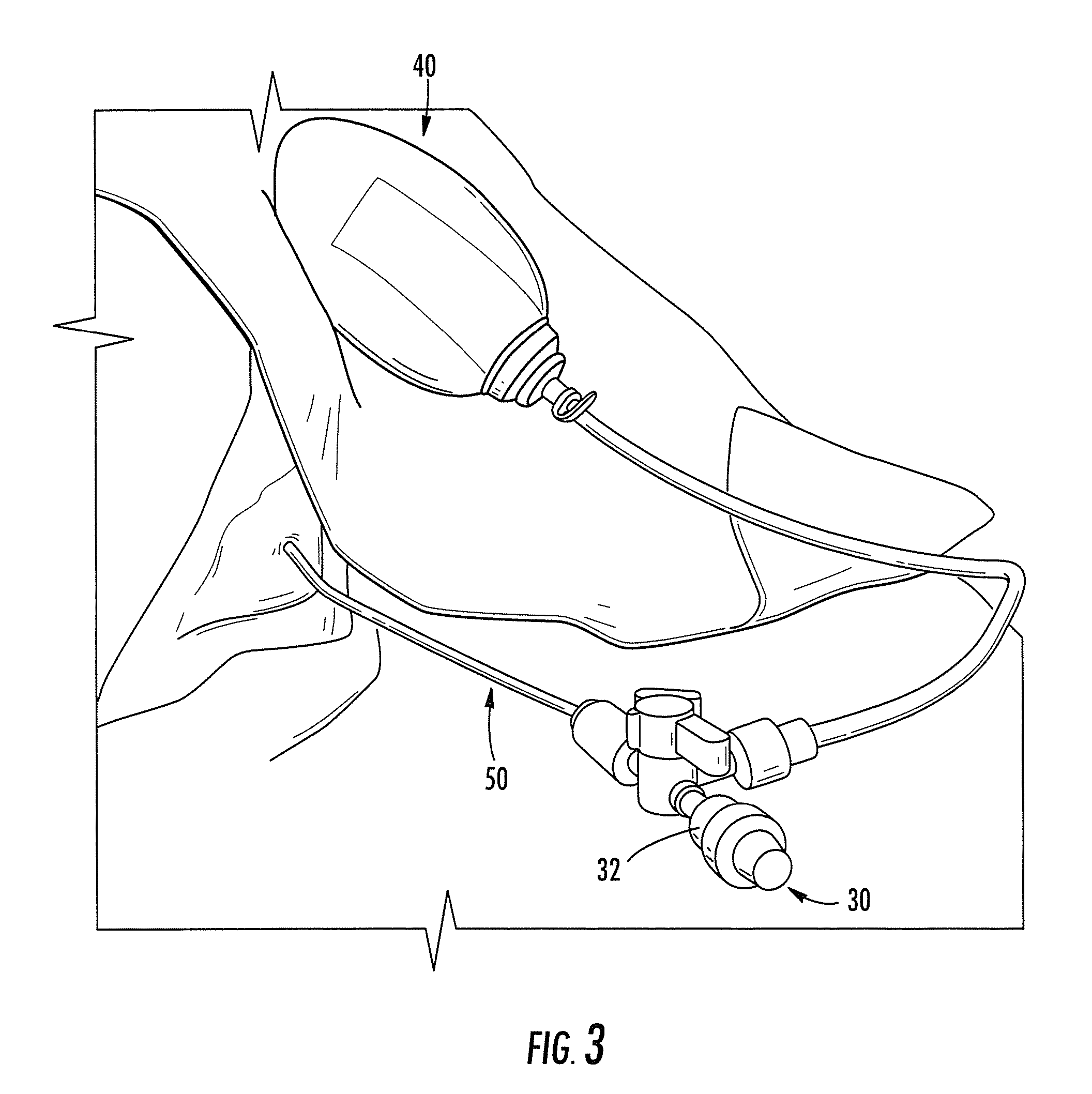 Subdural Drainage Catheter with Flow Restoration Mechanism