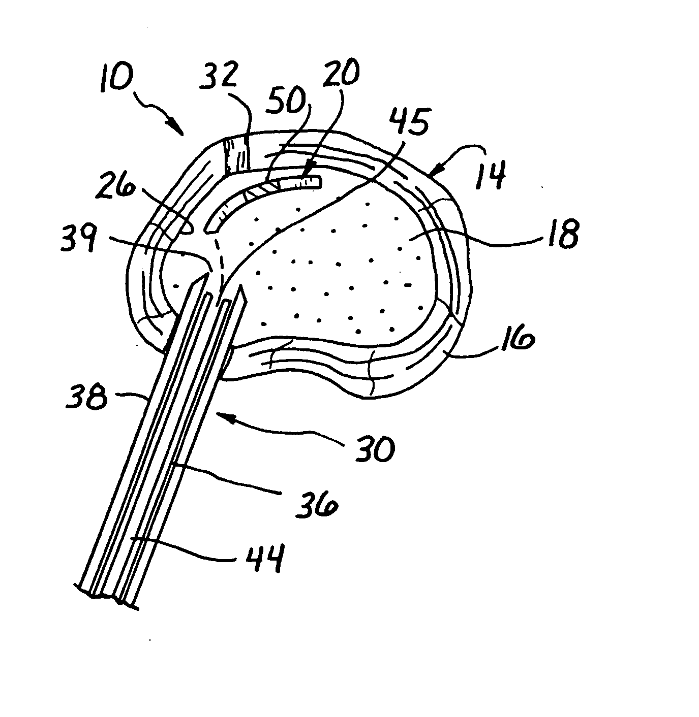 Spinal disc therapy system