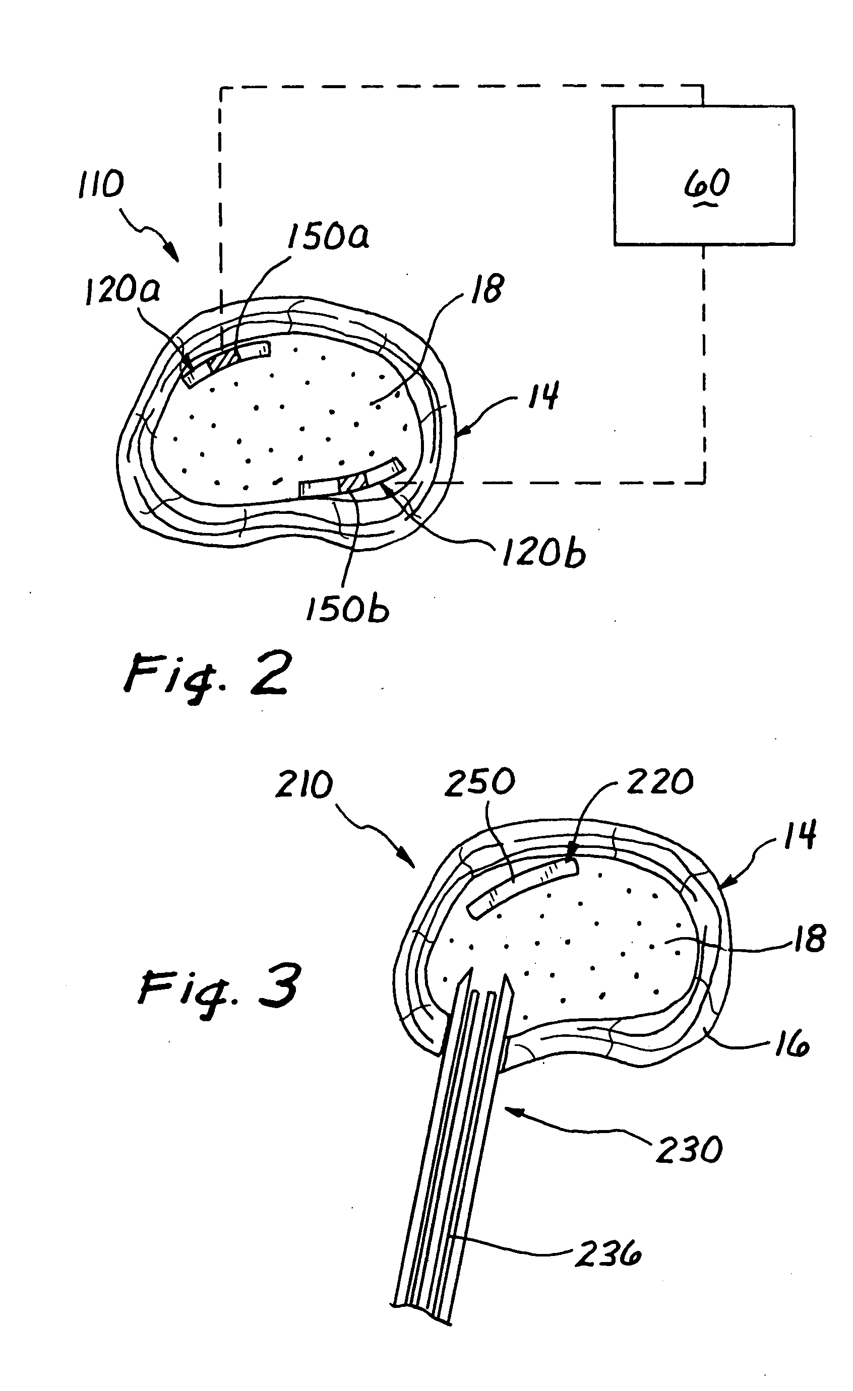 Spinal disc therapy system