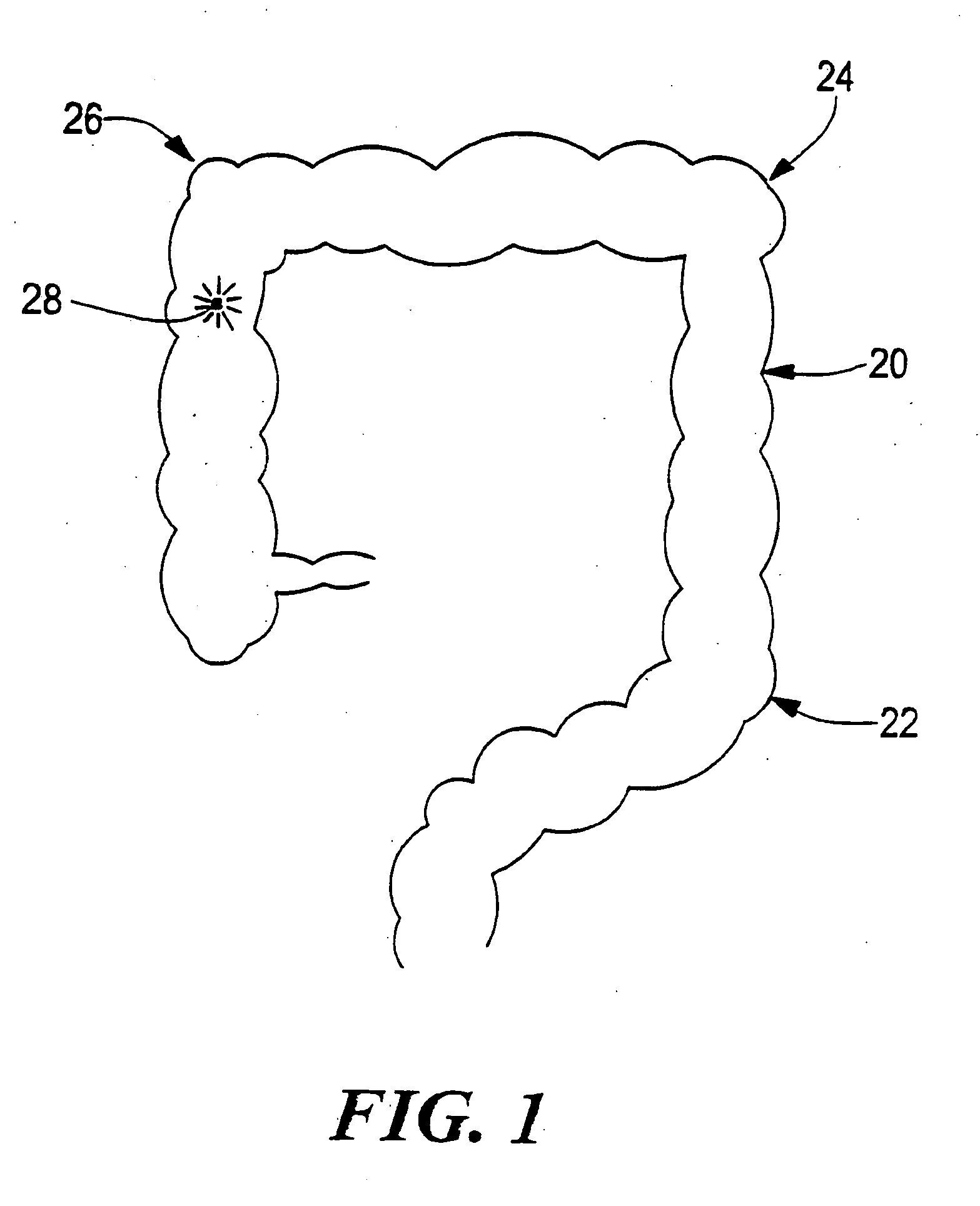 Method and product for locating an internal bleeding site