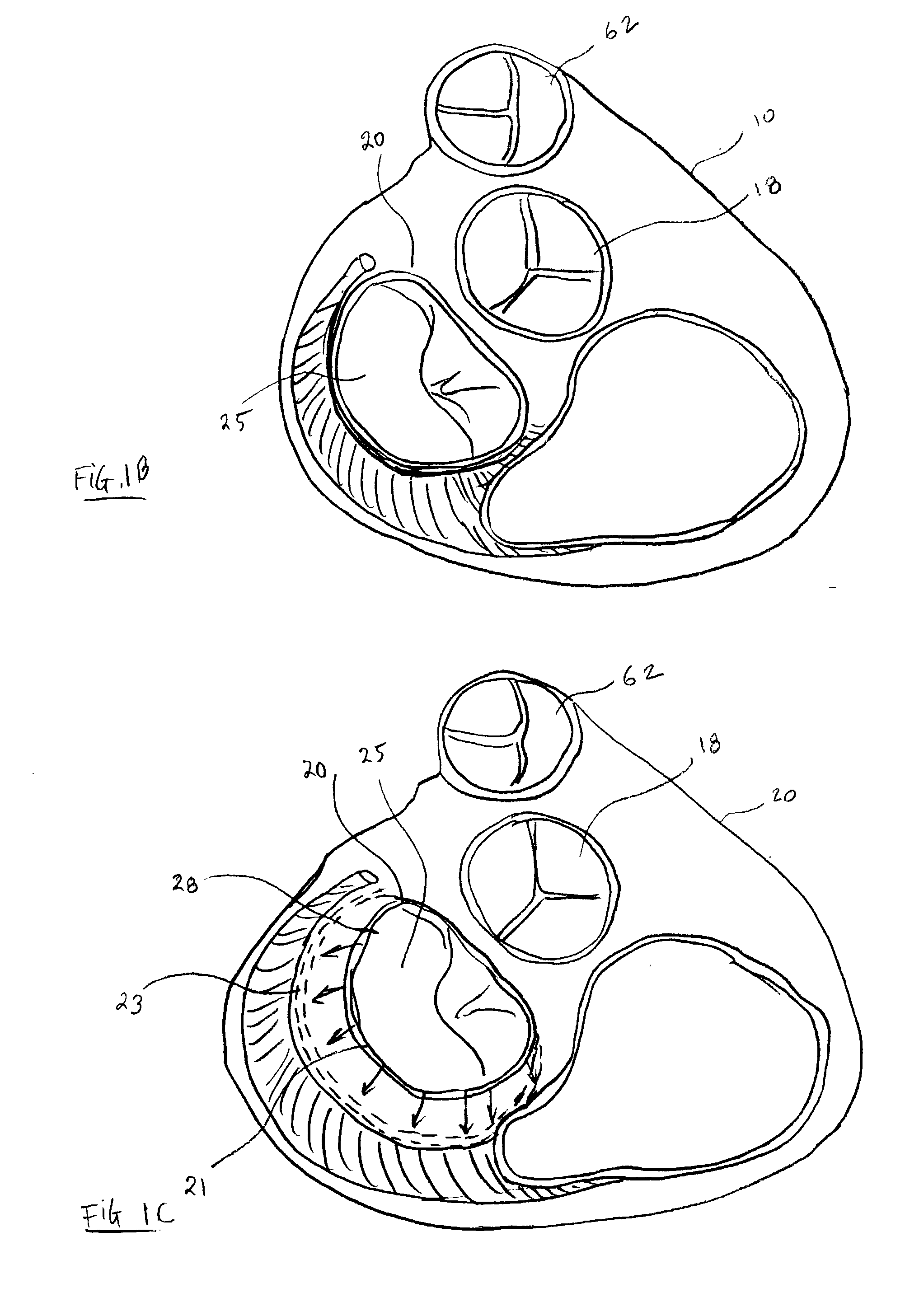 Apparatuses and methods for heart valve repair