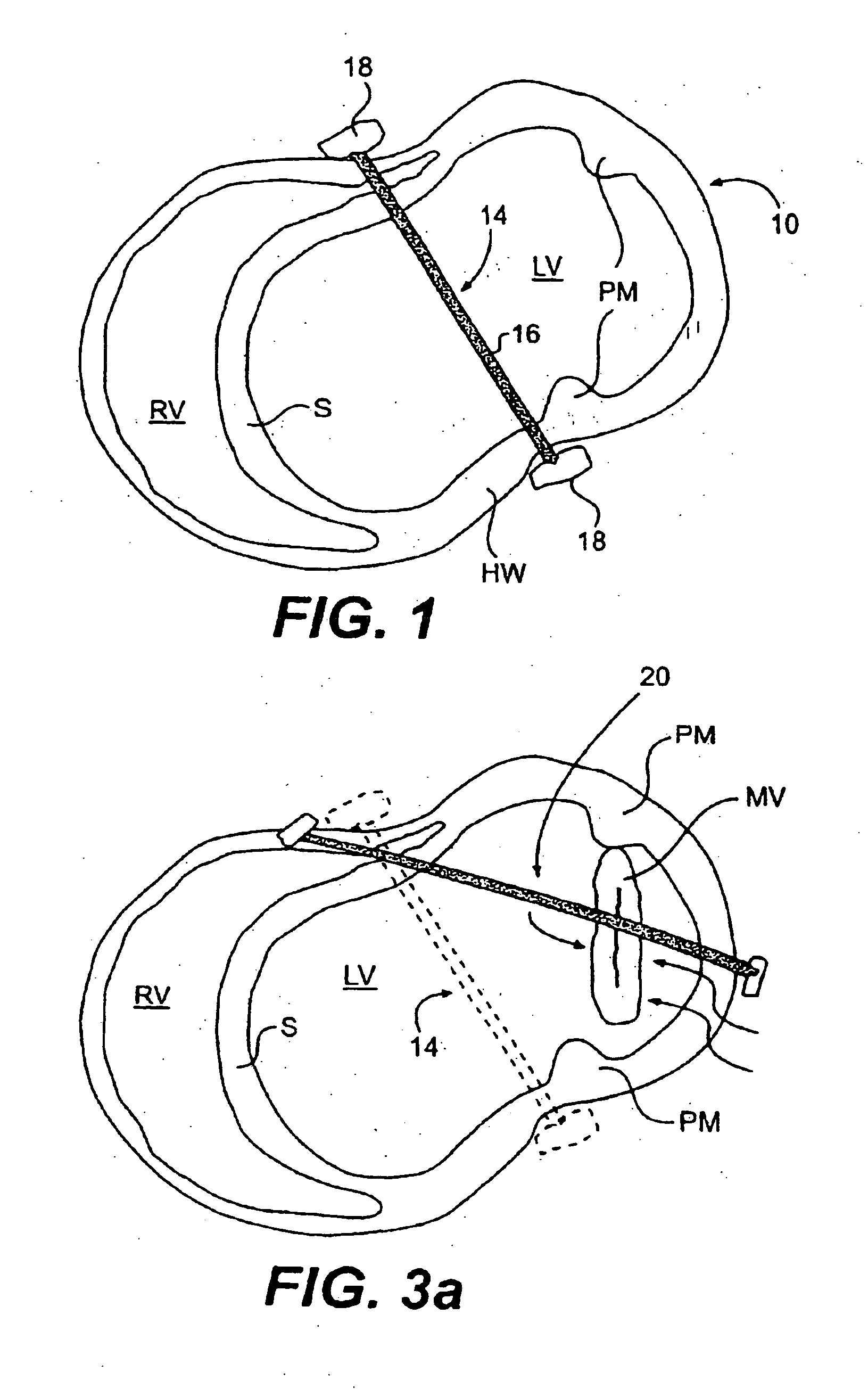 Methods and devices for improving mitral valve function