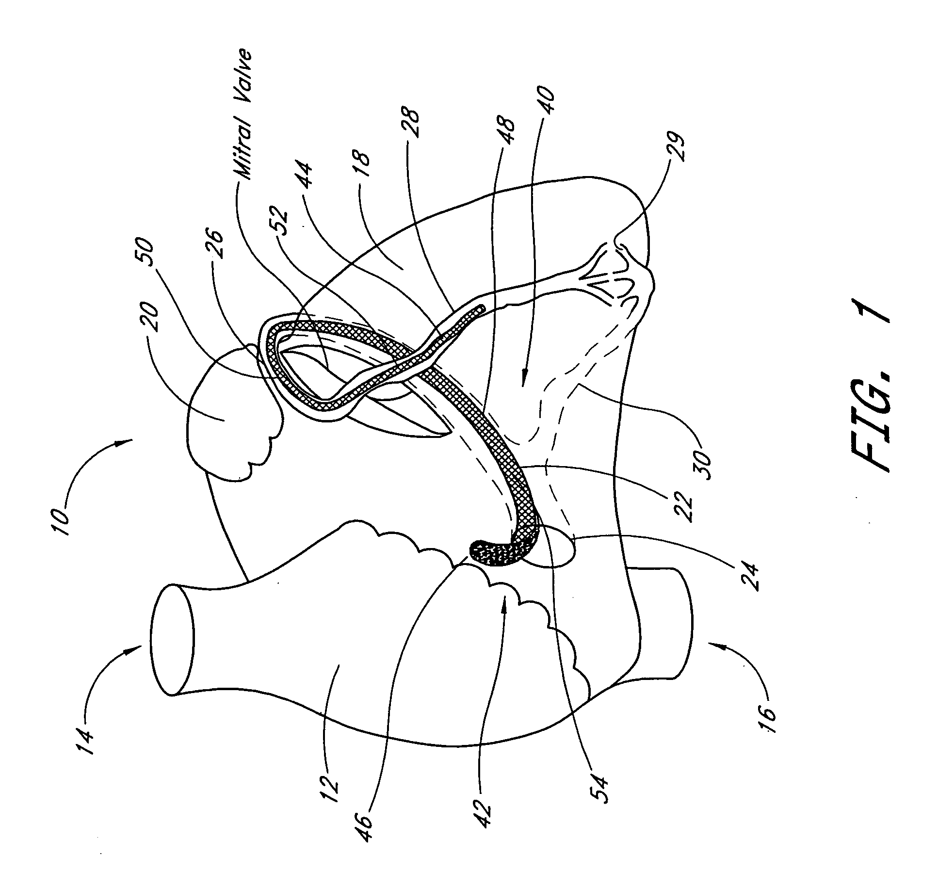 Transluminal mitral annuloplasty