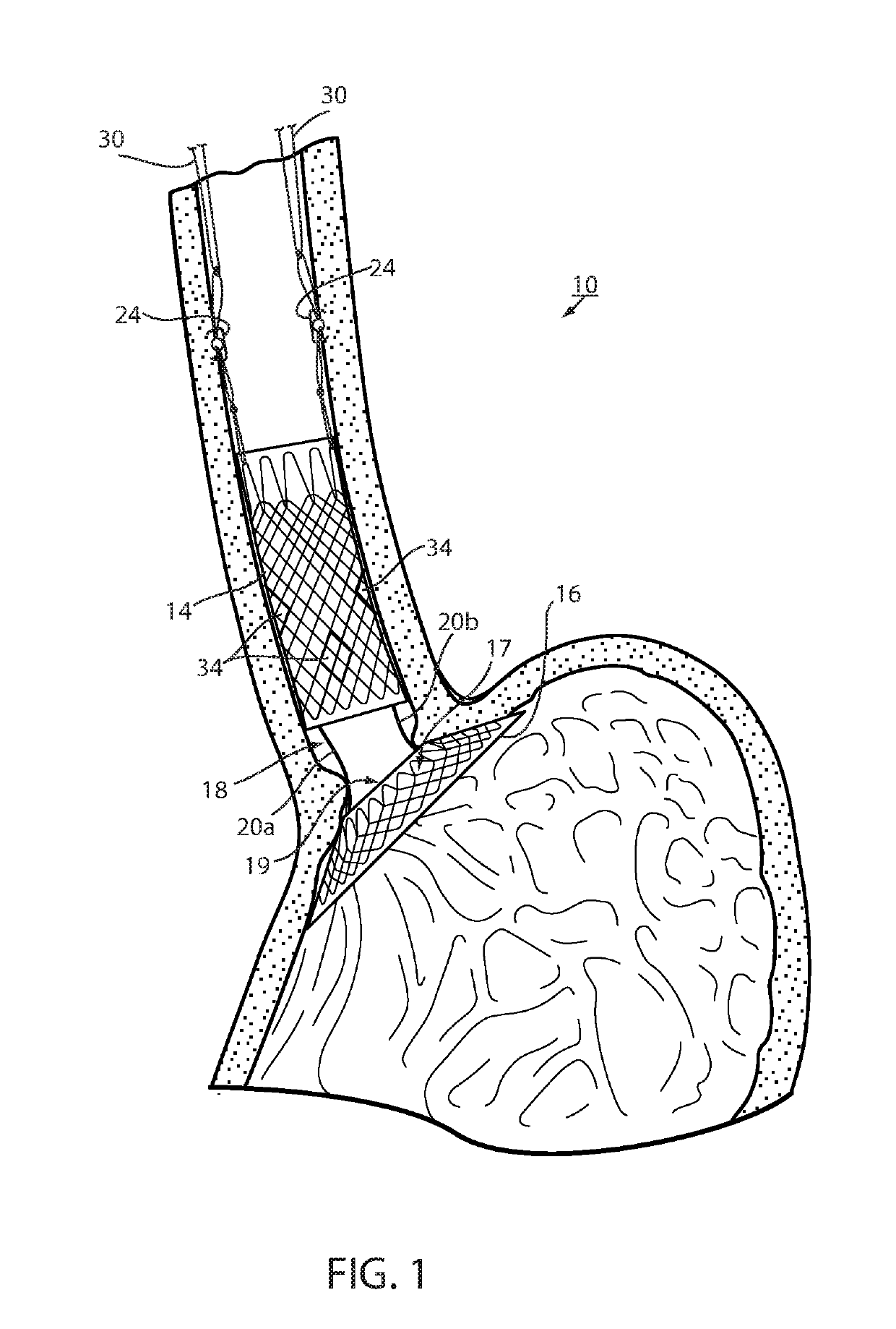 Fixation of intraluminal device