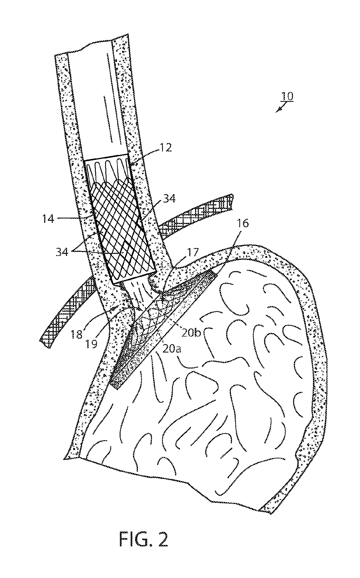 Fixation of intraluminal device