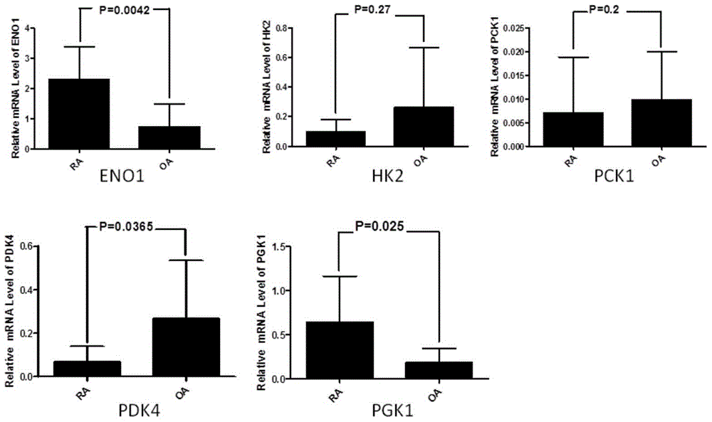 Application of phosphoglycerate kinase 1 in the preparation of diagnostic reagents for rheumatoid arthritis